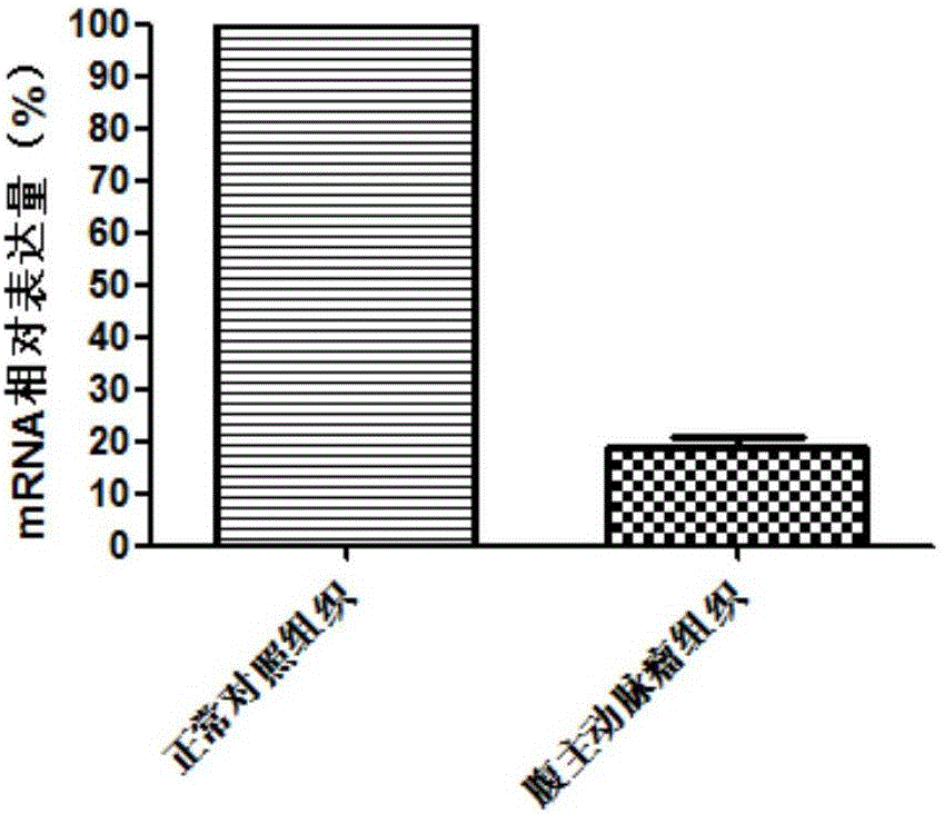 Application of SPHAR (S-phase response) as diagnosis and treatment target for abdominal aortic aneurysm