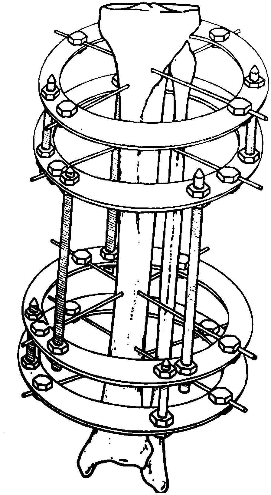 Ring type triangular synchronous control extender for thighbone