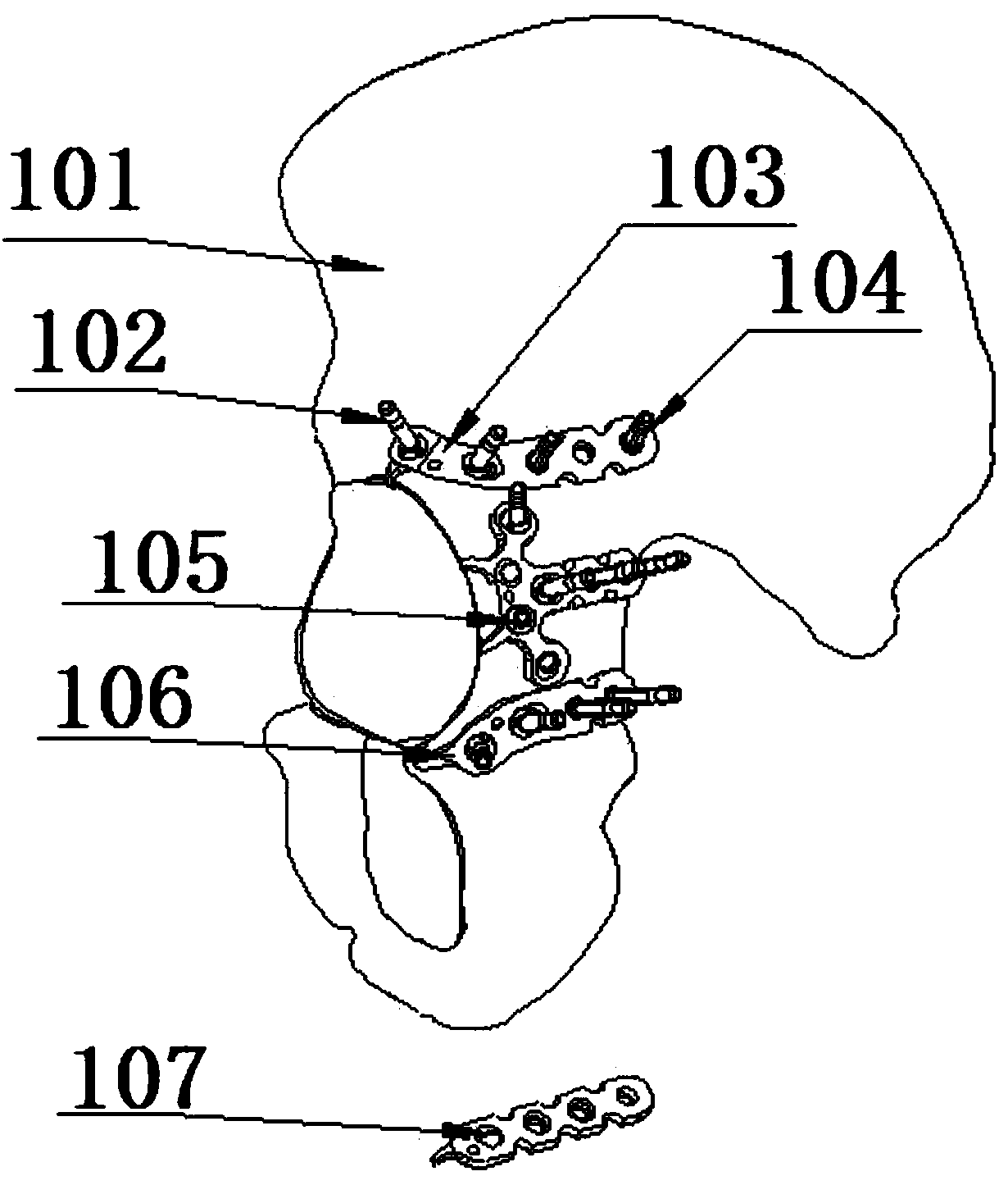 Inner combined fixing system for acetabular posterior wall