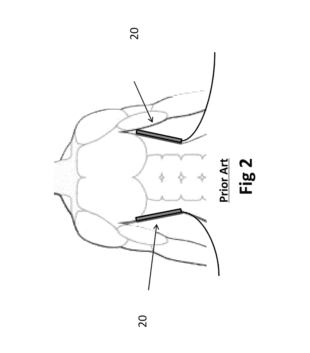 Apparatus and method for treating multiple tumors in patients with metastatic disease by electric fields