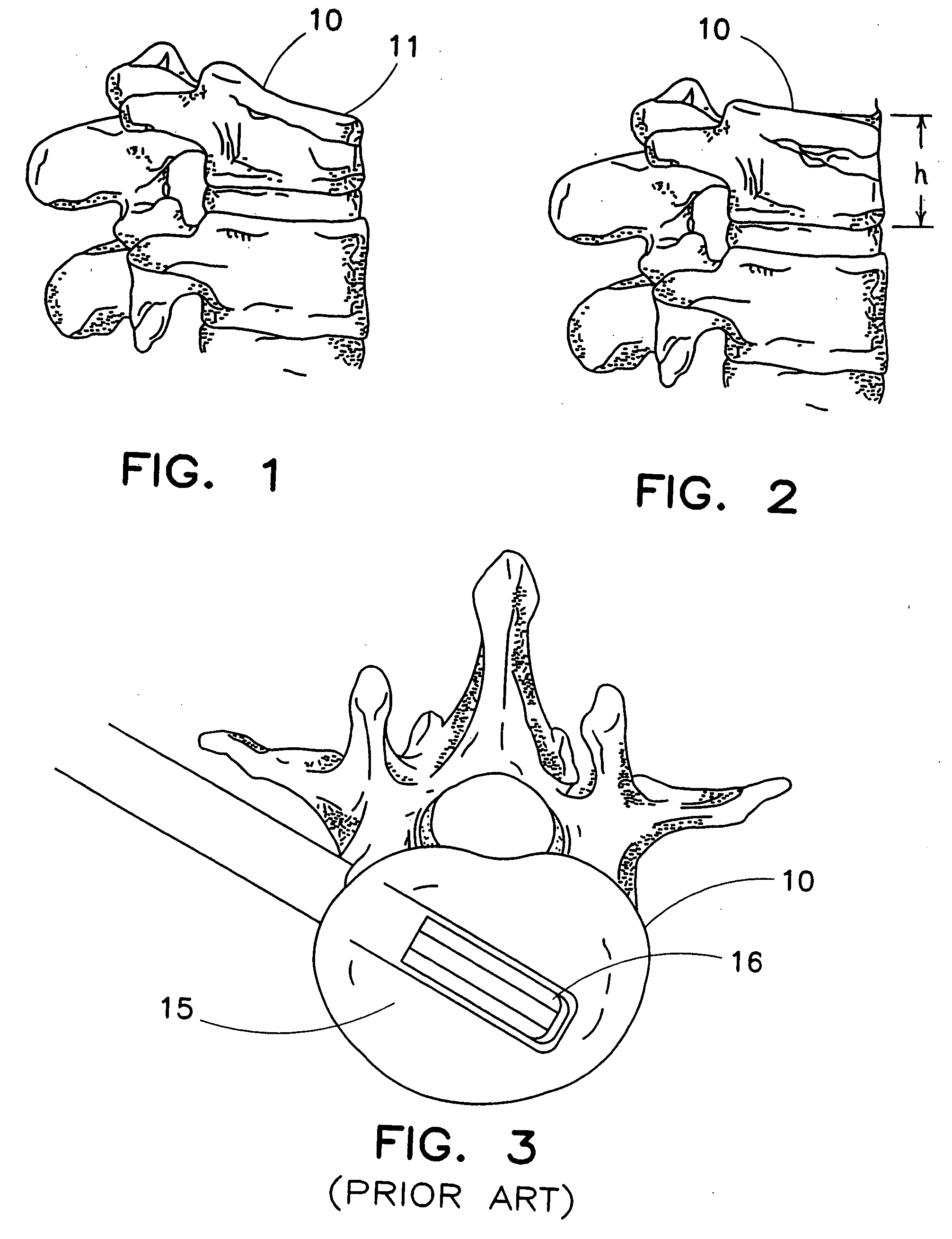 Tissue distraction device