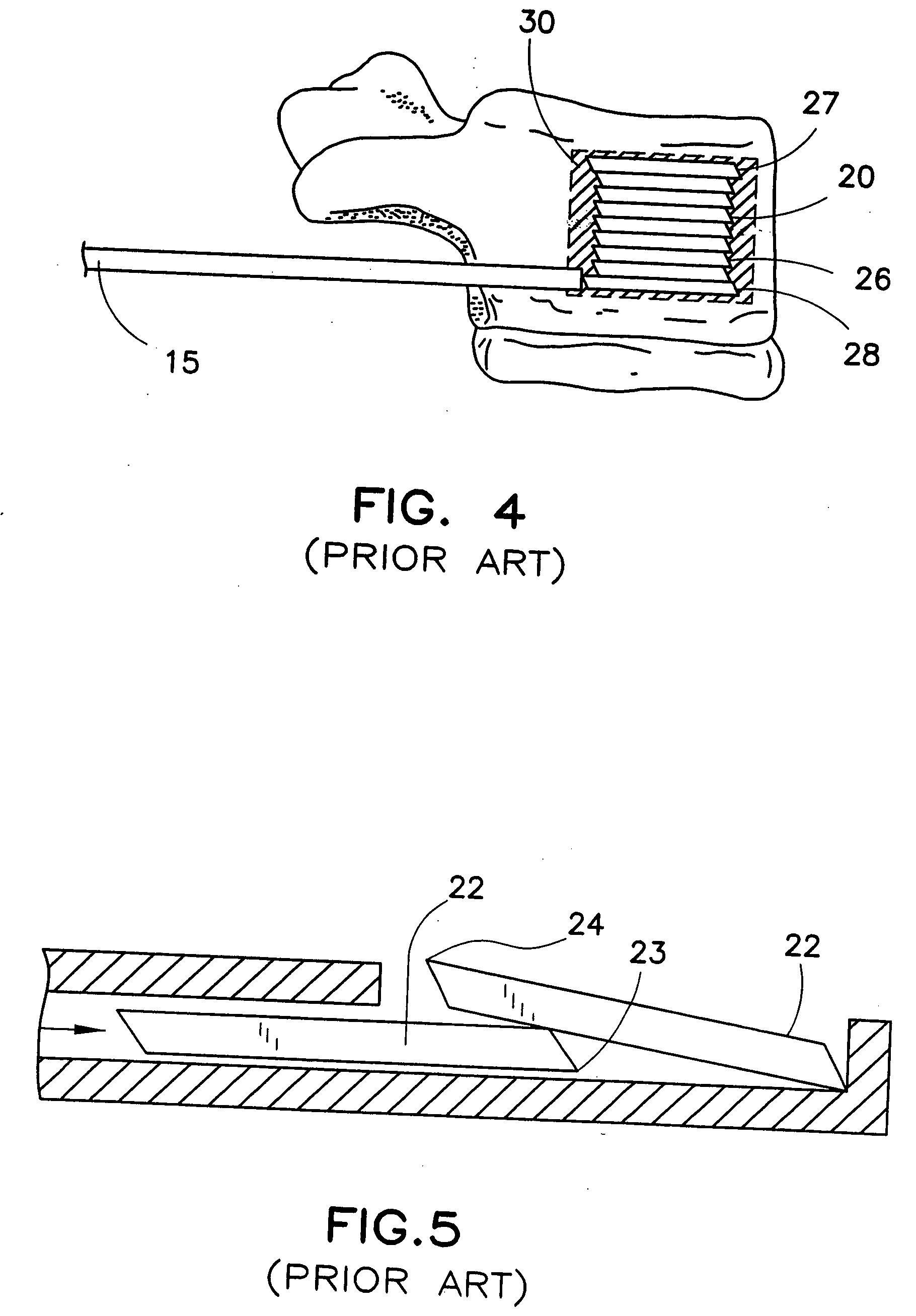 Tissue distraction device