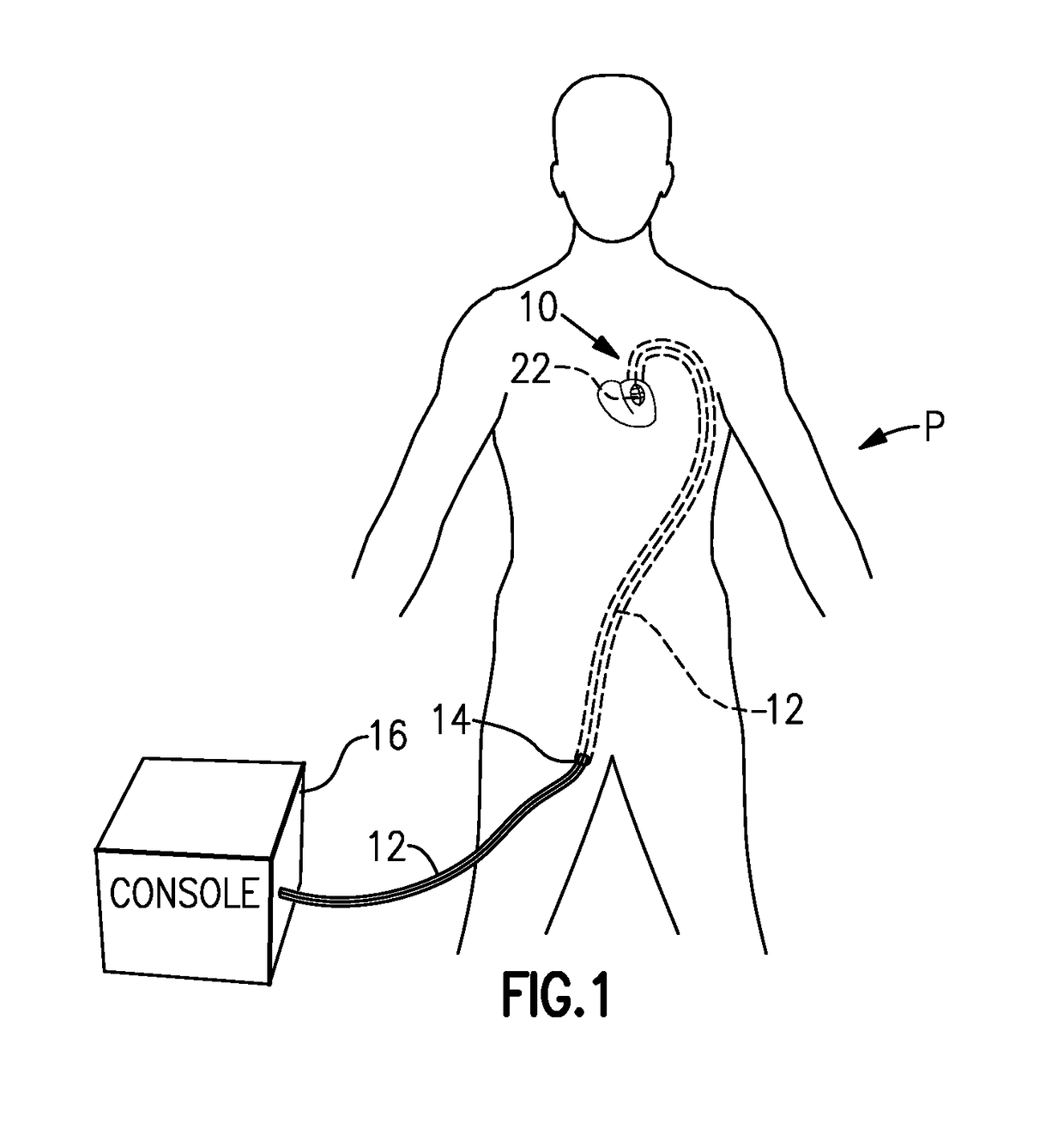 Left ventricle heart-assist device