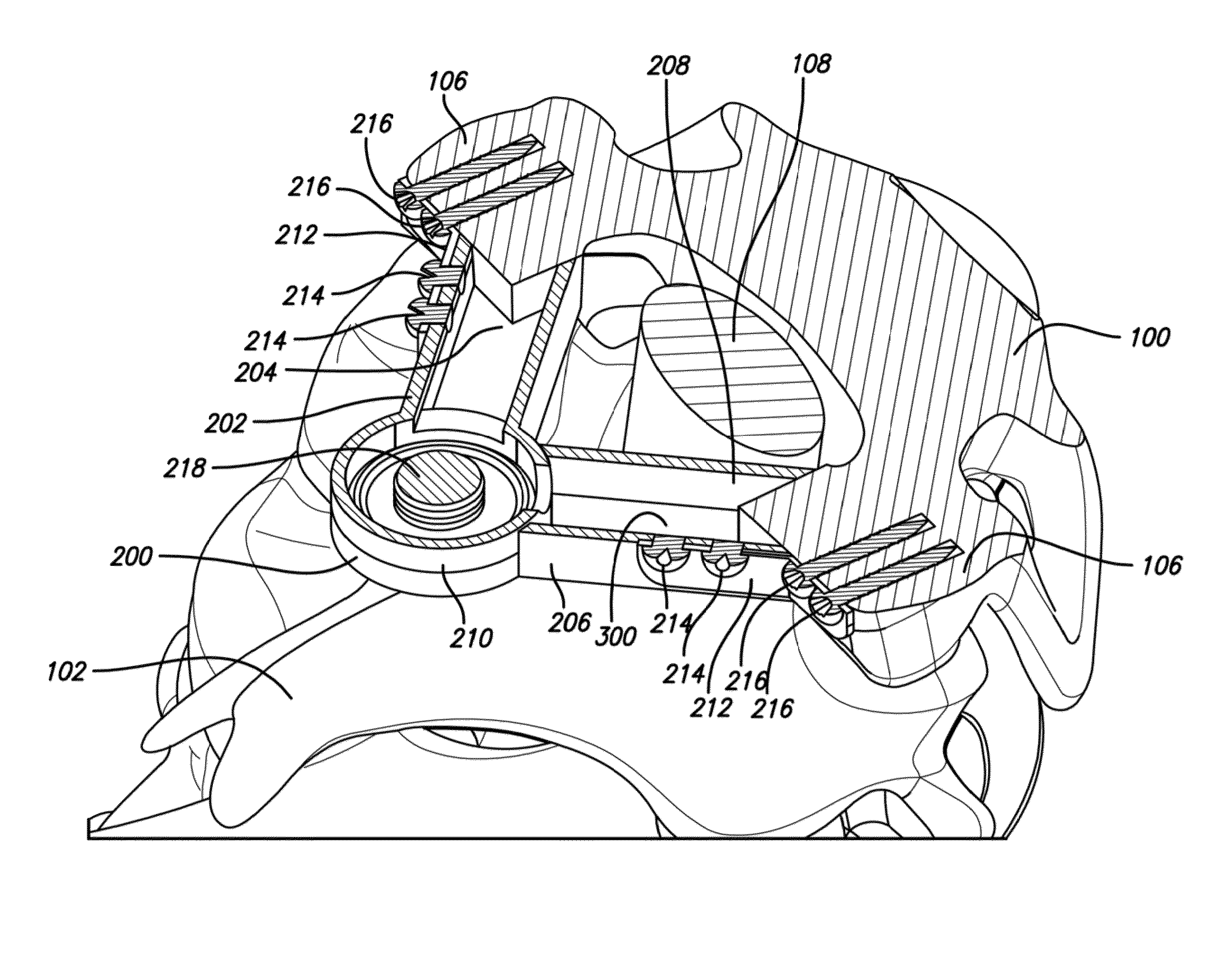 Lamina implant and method