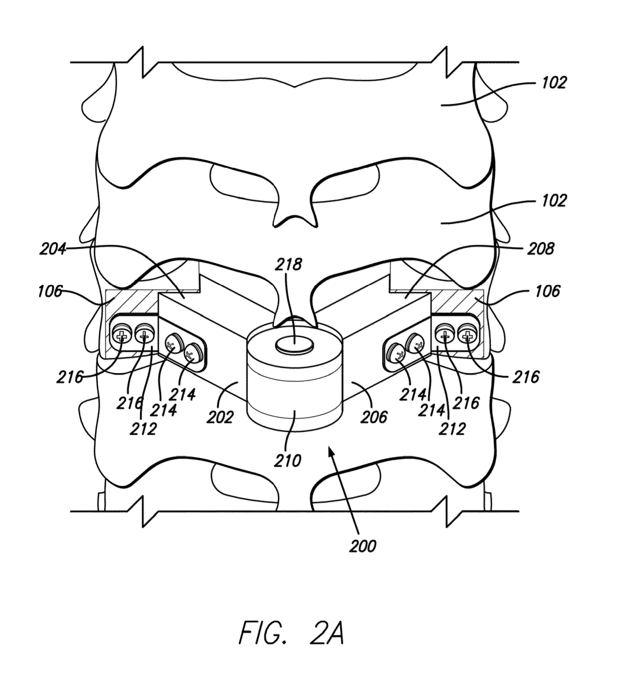 Lamina implant and method