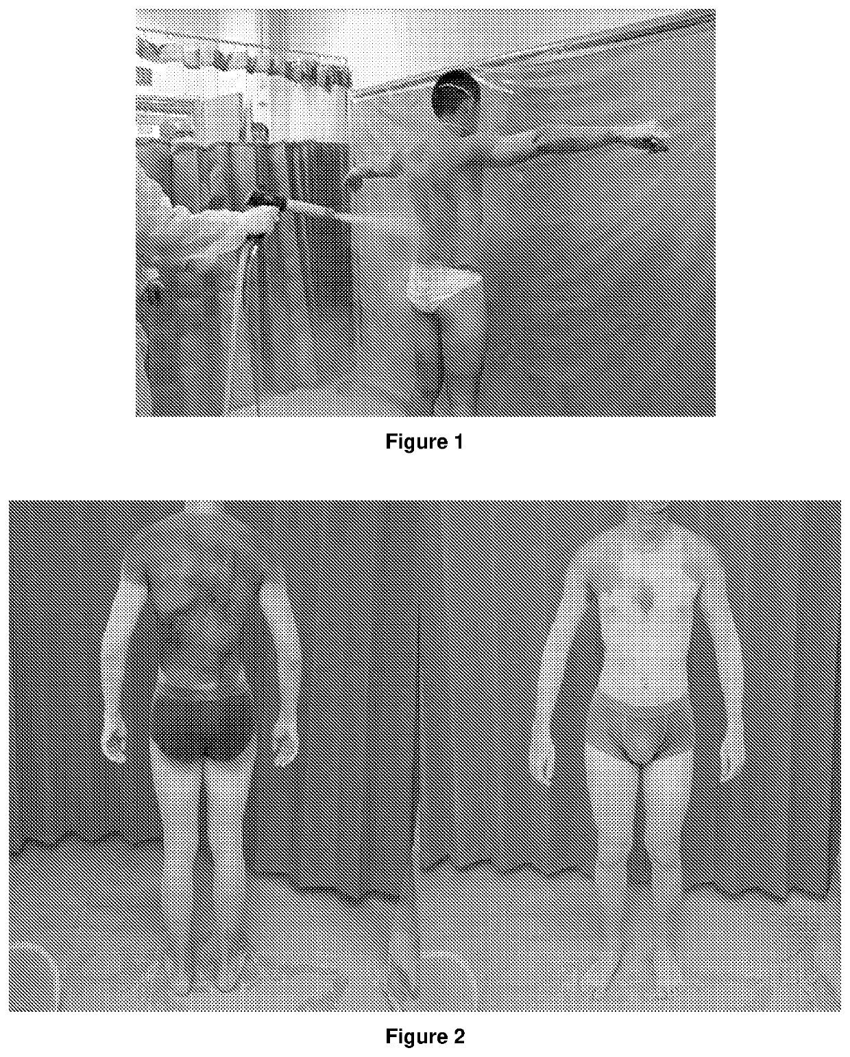 Treatment of idiopathic hypohidrosis