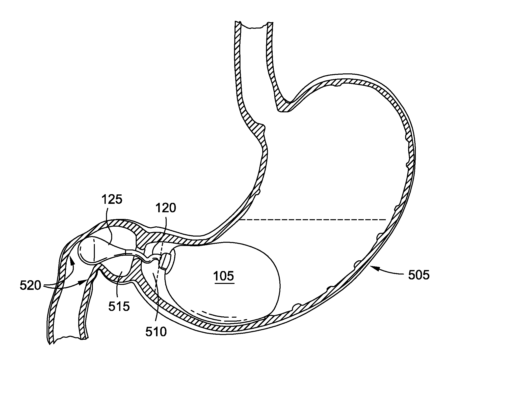 Intragastric implants with duodenal anchors