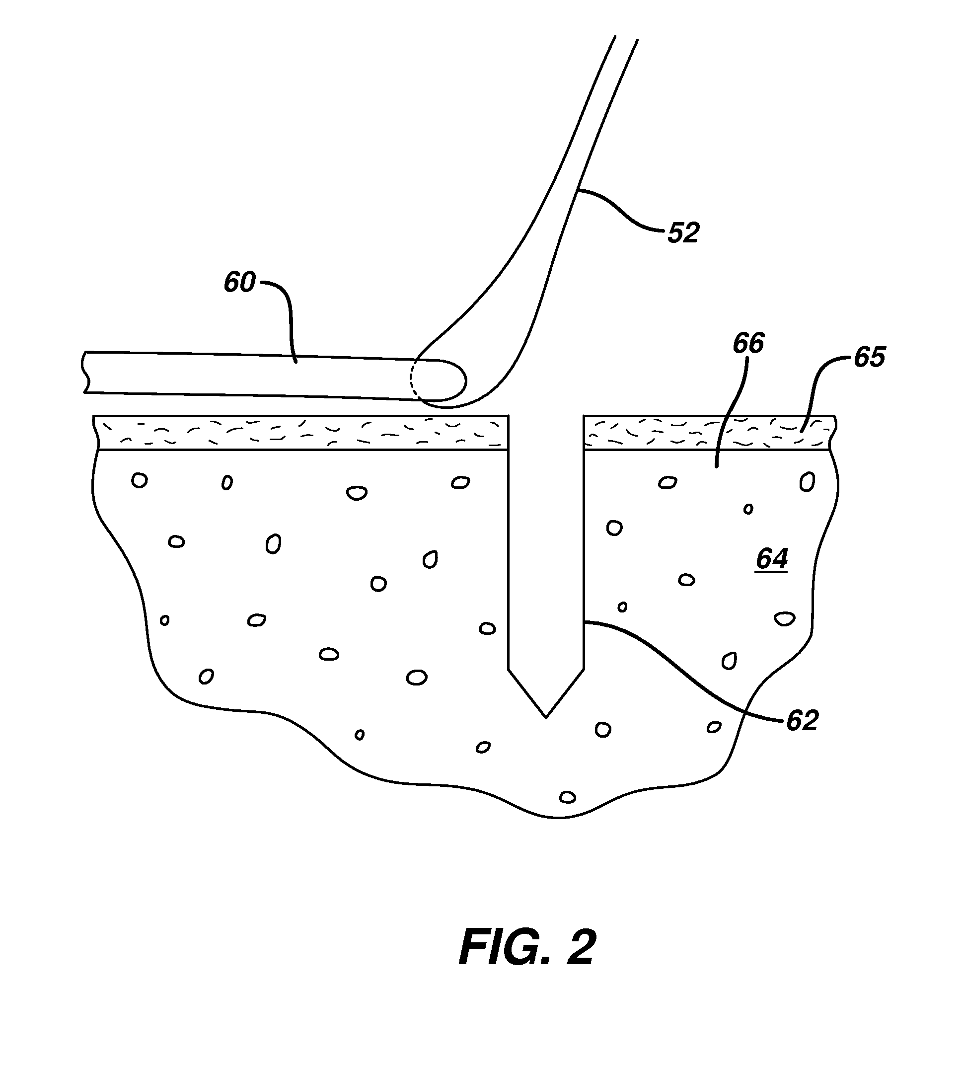 Knotless suture anchor