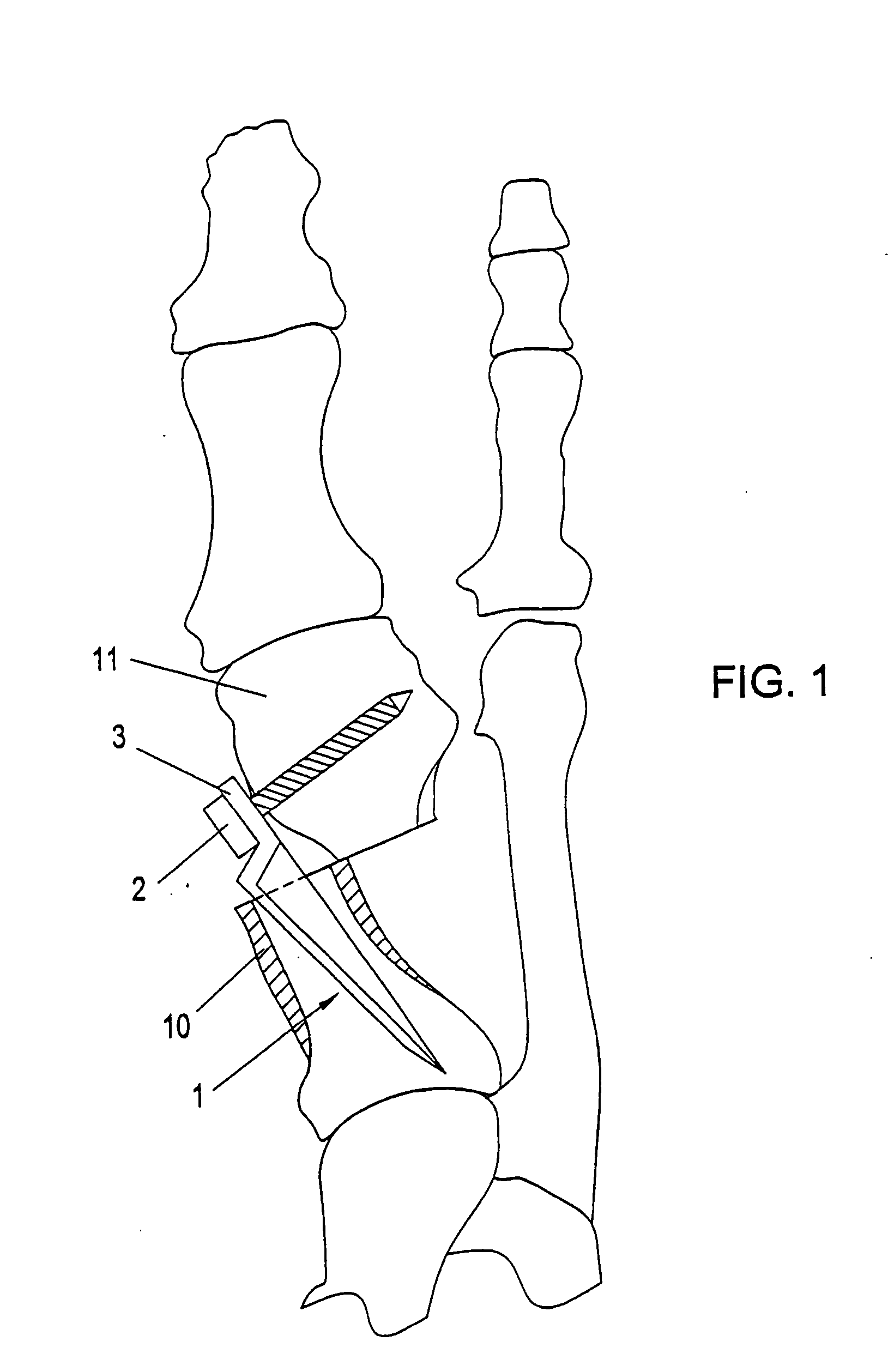 Implant for the dynamic fixation of a corrective osteotomy