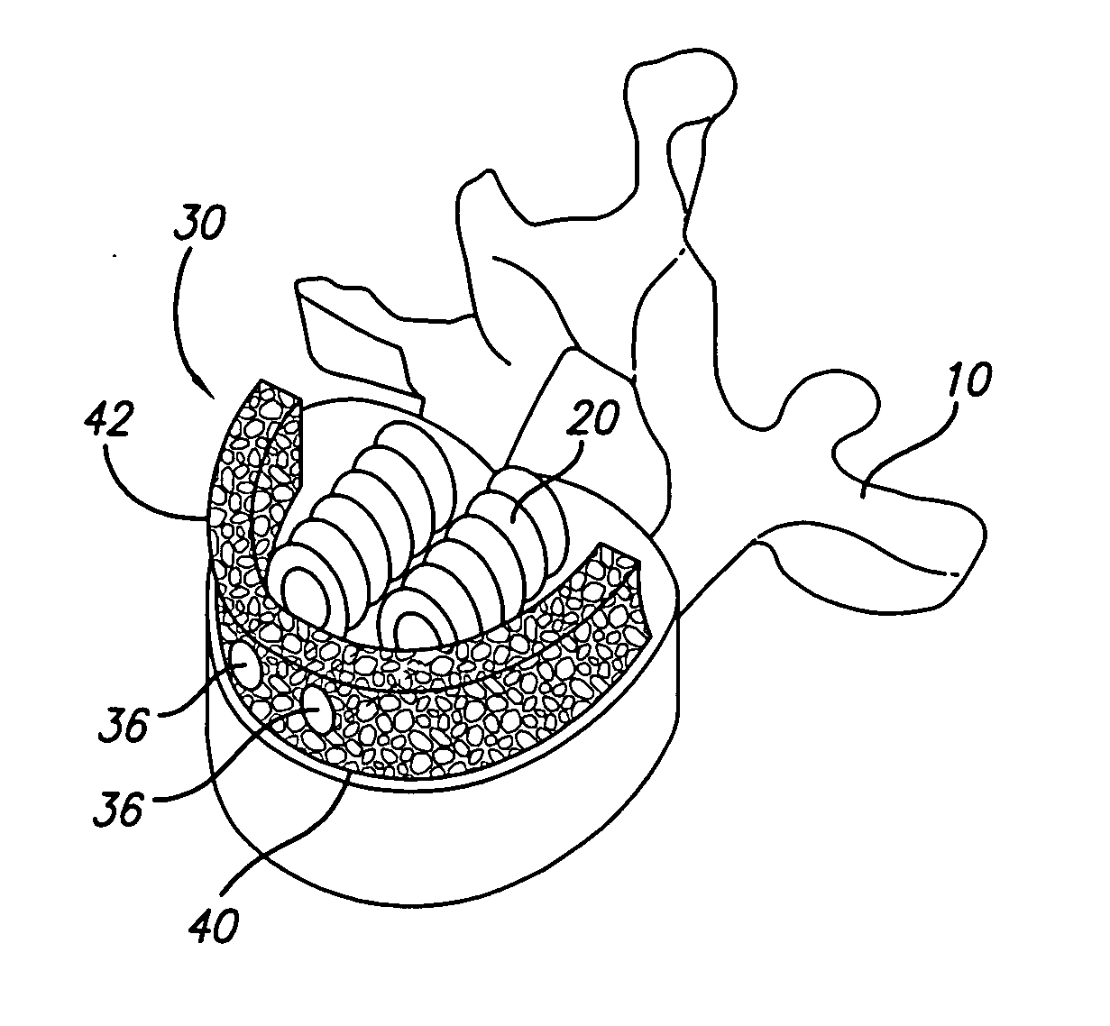 Support device for vertebral fusion