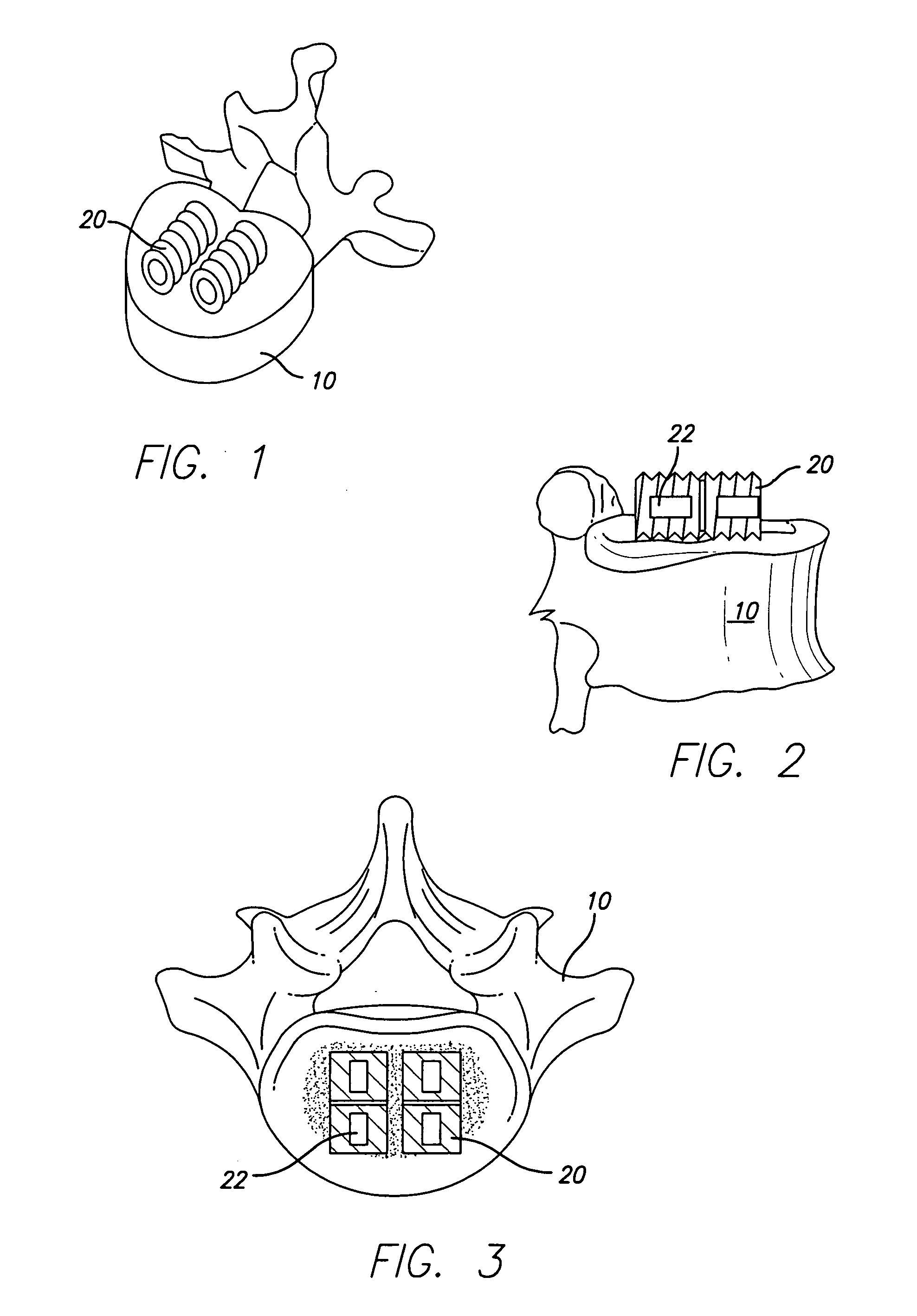 Support device for vertebral fusion