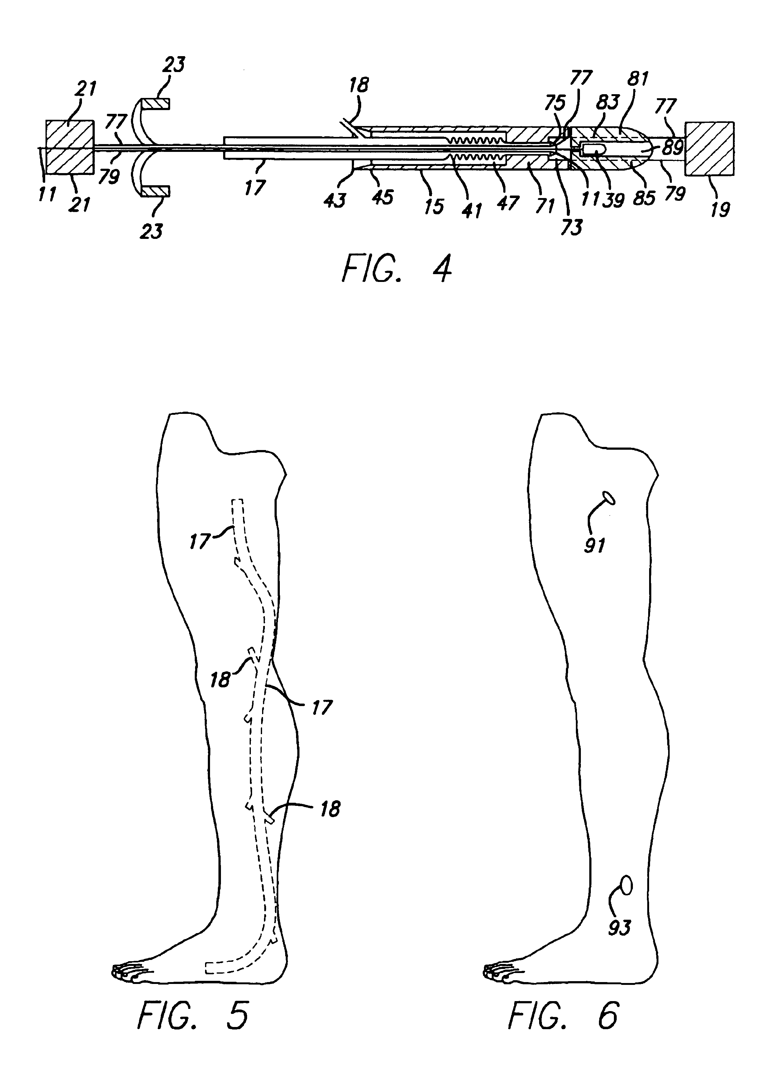 Method and apparatus for vessel harvesting