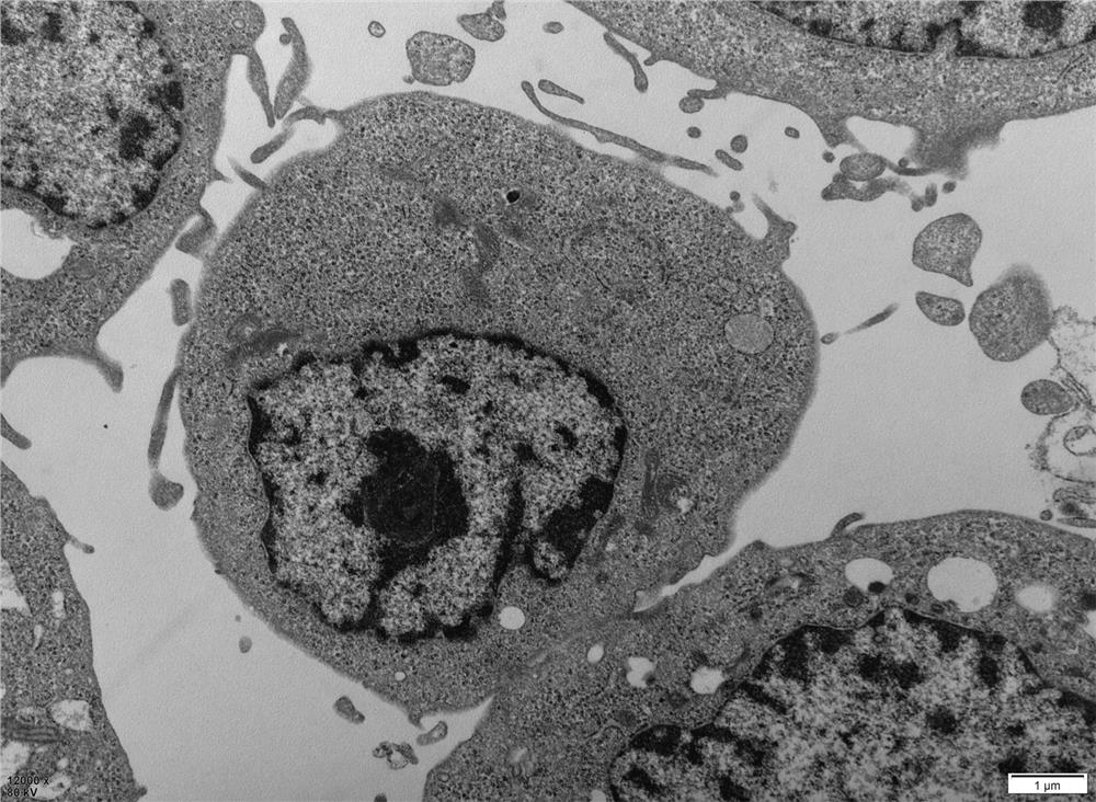 Lymph node-derived lymphoma-related fibroblast tumor cell strain and application thereof