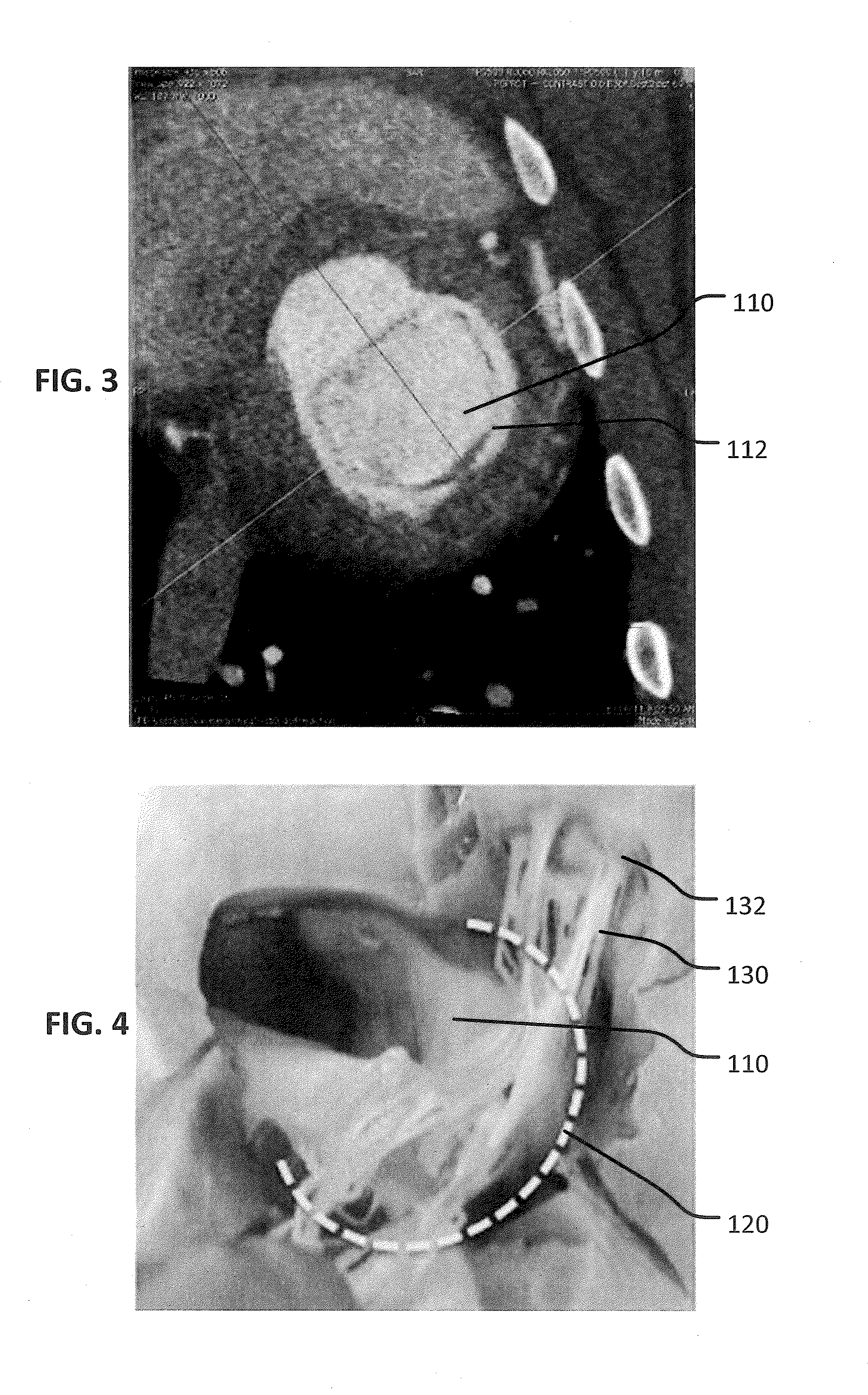 Two stage anchor and mitral valve assembly