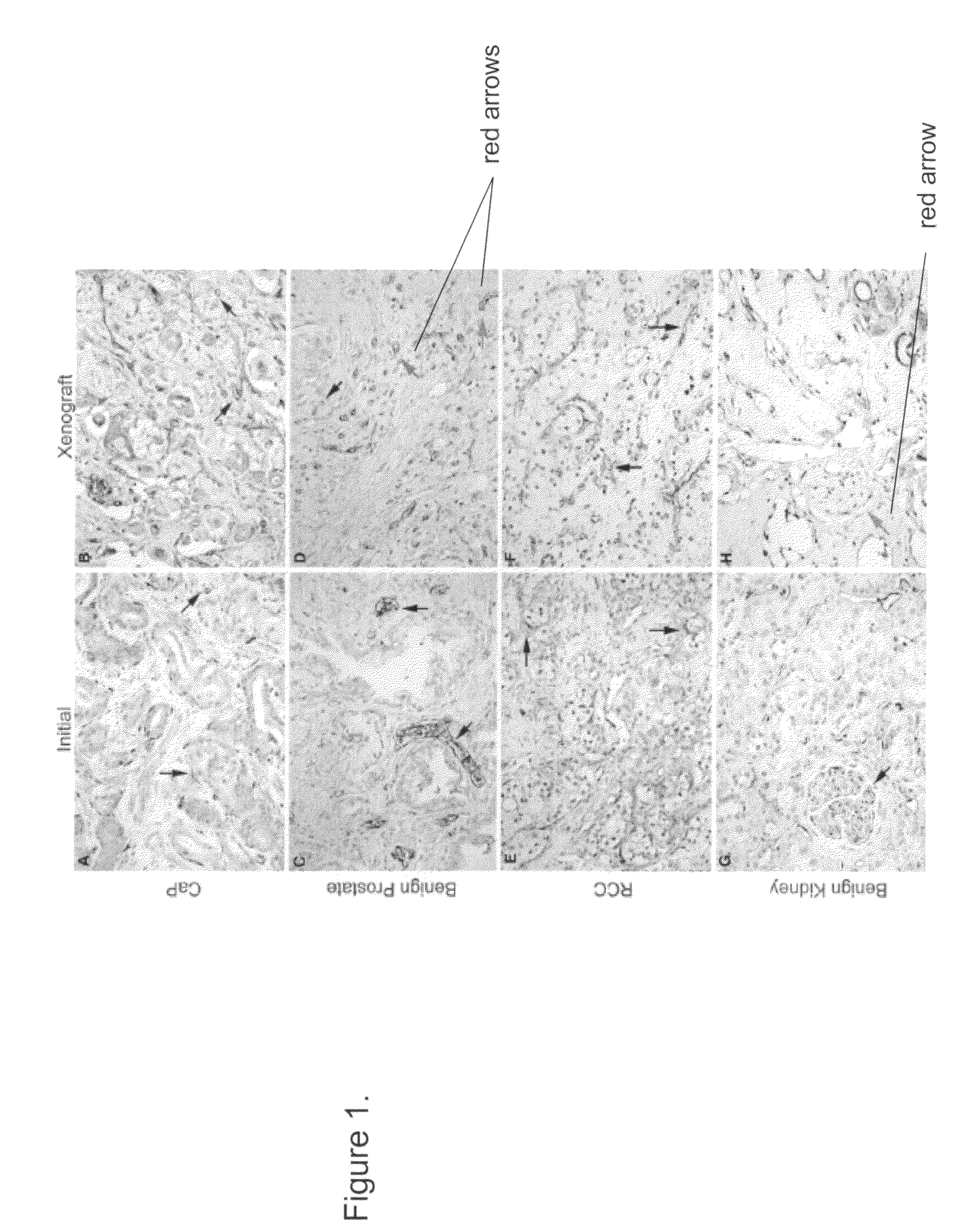 Methods for evaluating and implementing prostate disease treatments