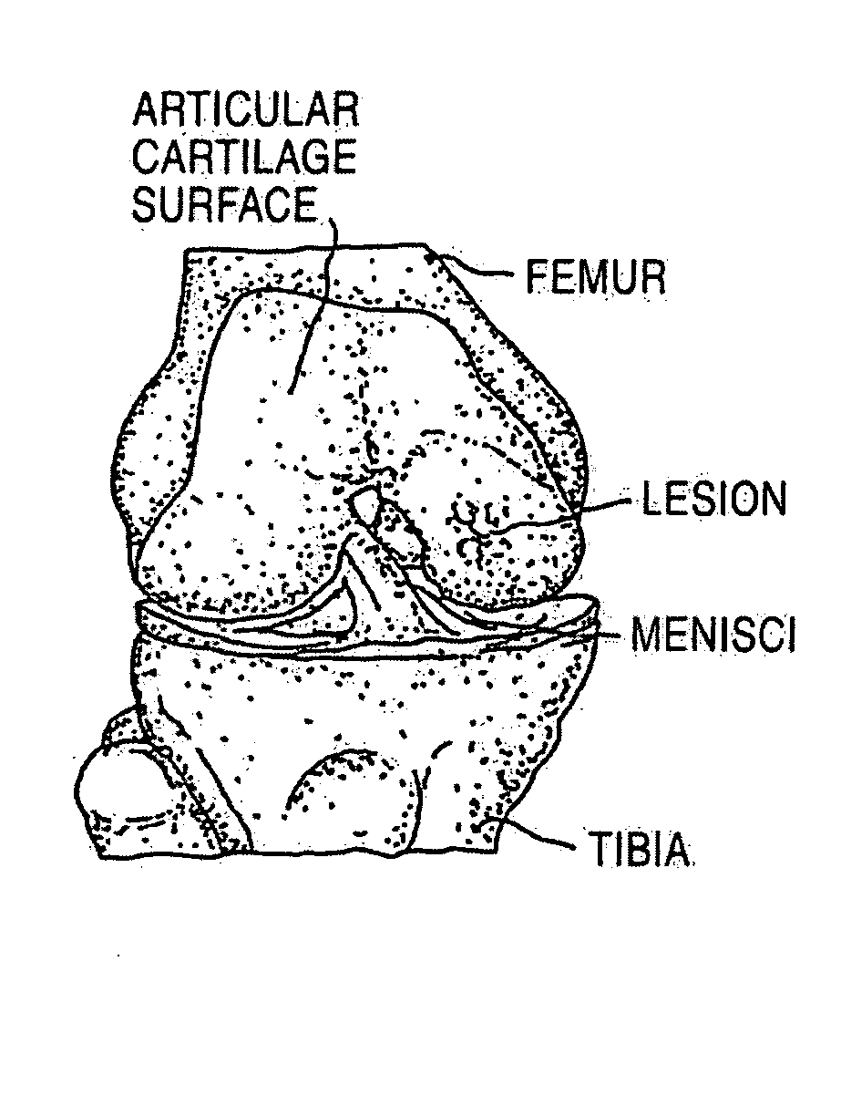 Cancellous construct with support ring for  repair of osteochondral defects