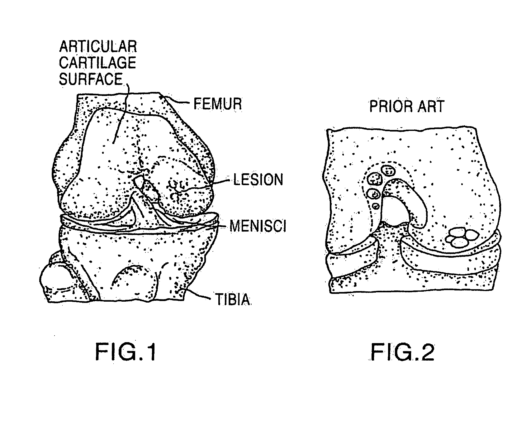 Cancellous construct with support ring for  repair of osteochondral defects