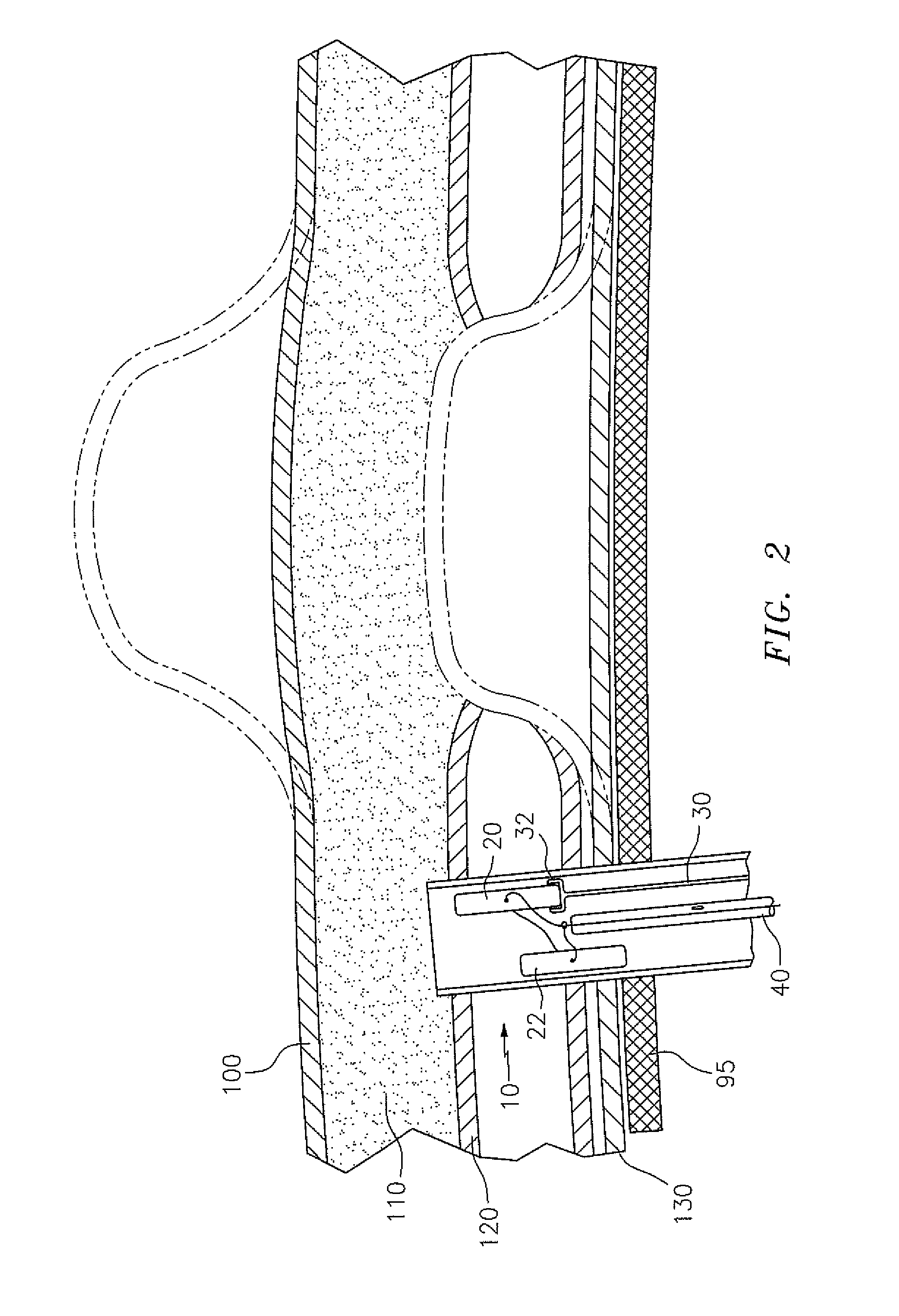 Assemblies and Methodologies for Internal Transfascial Mesh Fixation