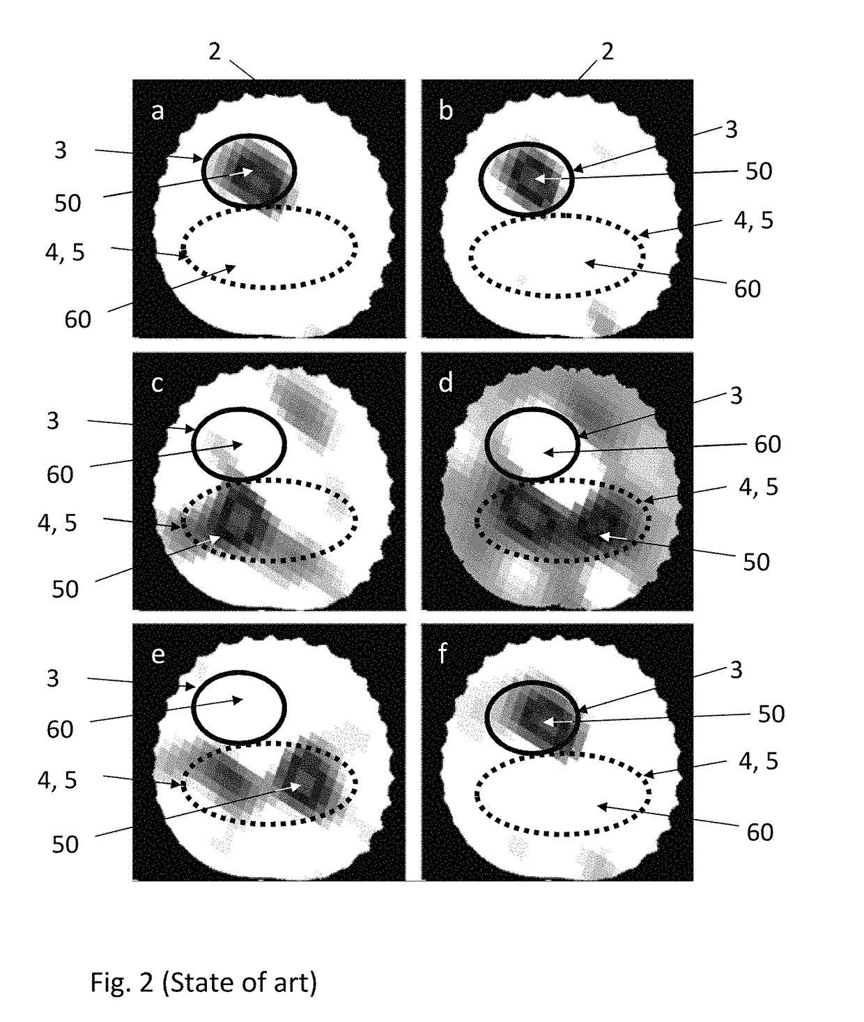 Method and apparatus for the non-invasive measurement of pulse transit times (PTT)