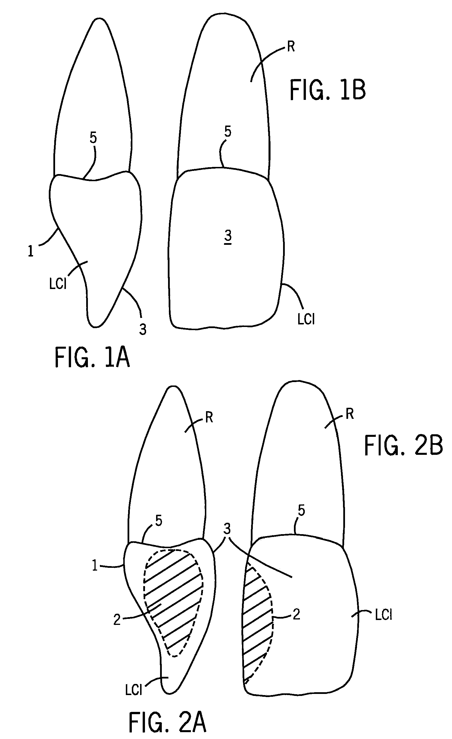 Dental Matrix Devices Specific To Anterior Teeth, and Injection Molded Filling Techniques and Devices