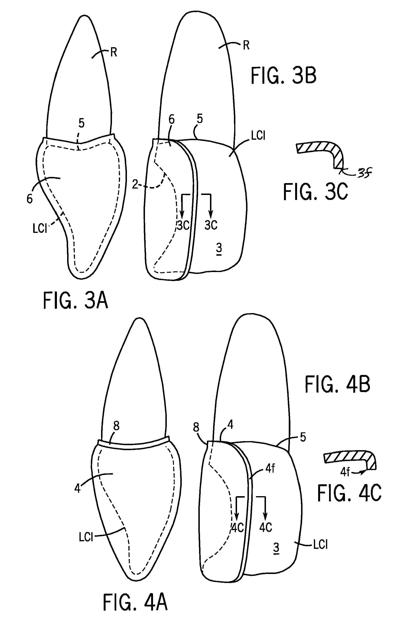 Dental Matrix Devices Specific To Anterior Teeth, and Injection Molded Filling Techniques and Devices