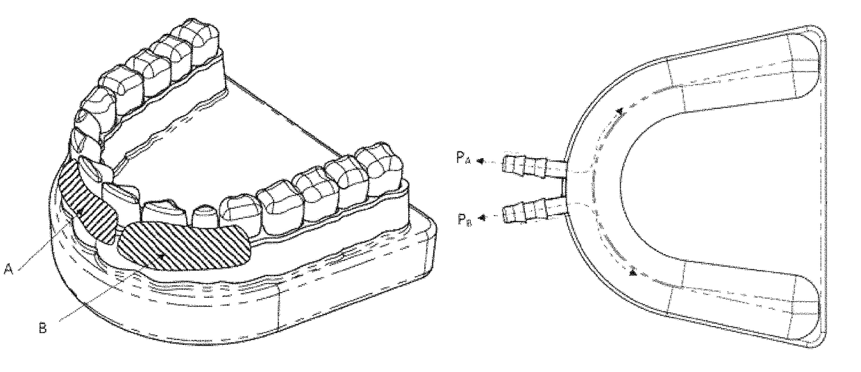 Negative pressure wound therapy for treatment of periodontal disease