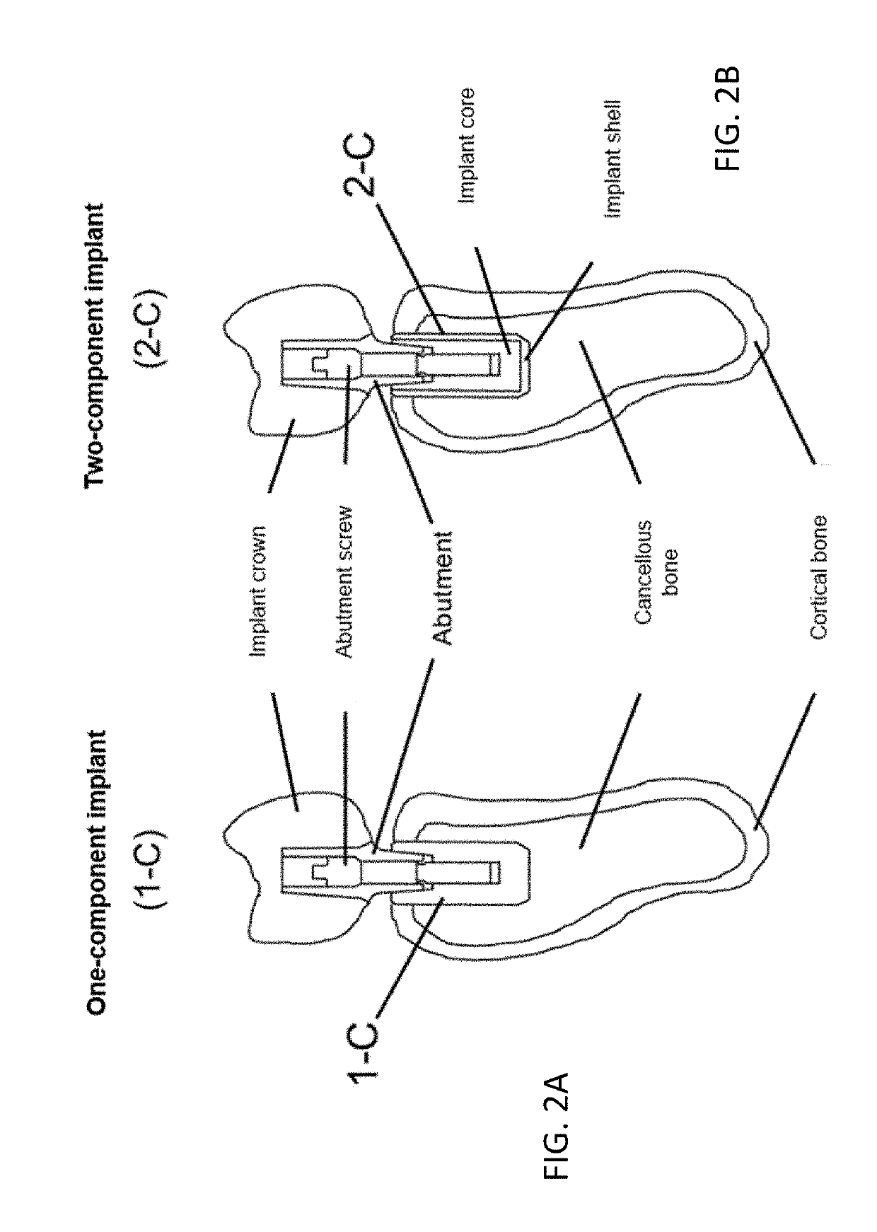 Implant made of fibre-reinforced plastic