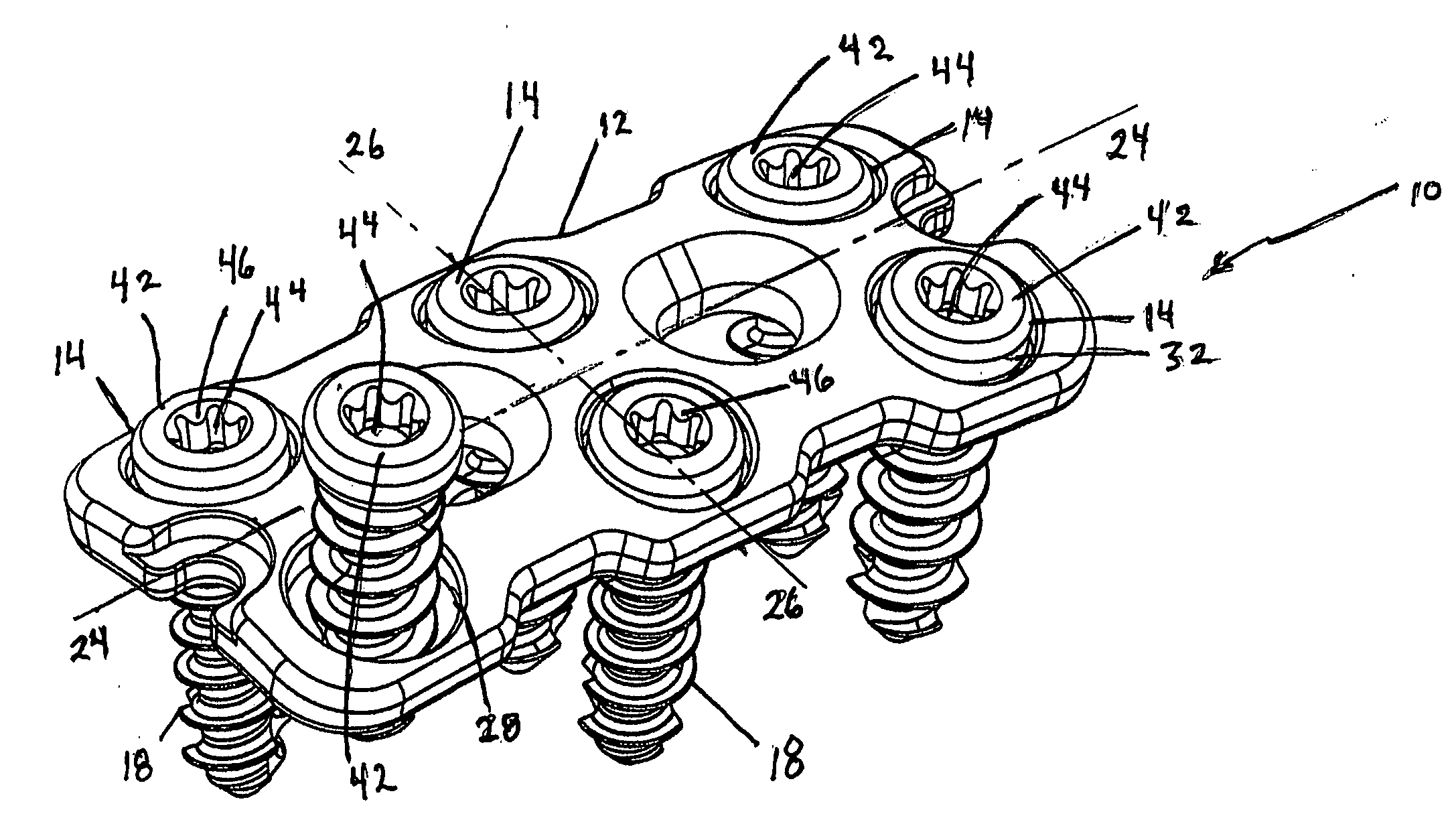 Anterior vertebral plate with closed thread screw