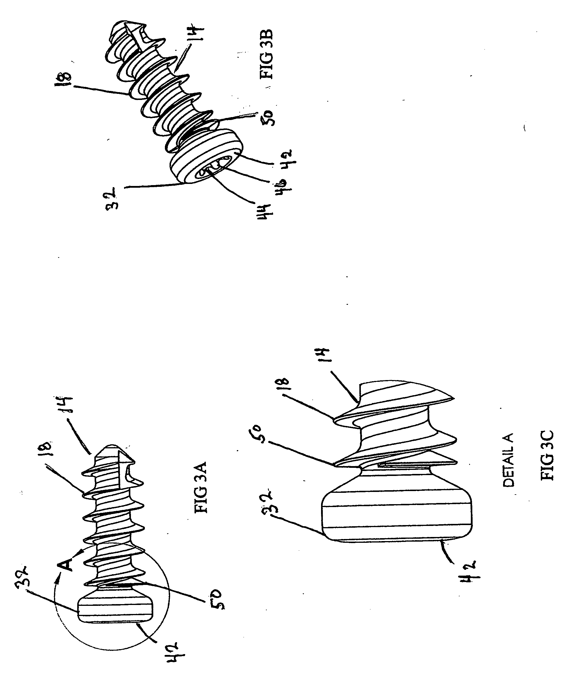 Anterior vertebral plate with closed thread screw