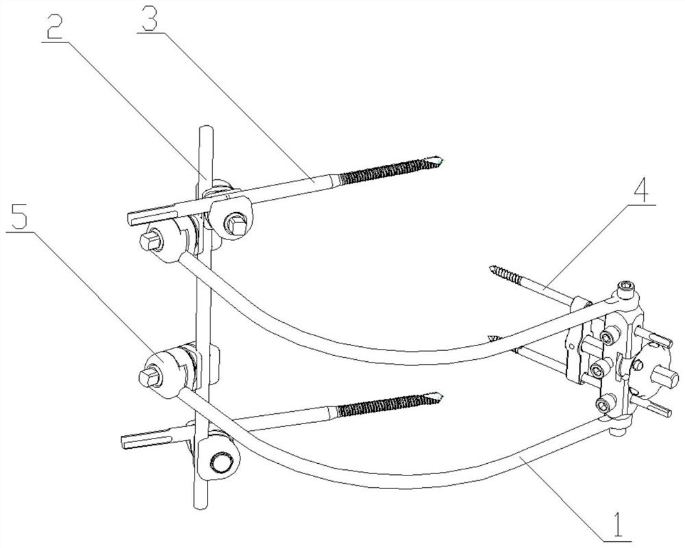 External fixing frame device for fibula transverse bone carrying and using method thereof