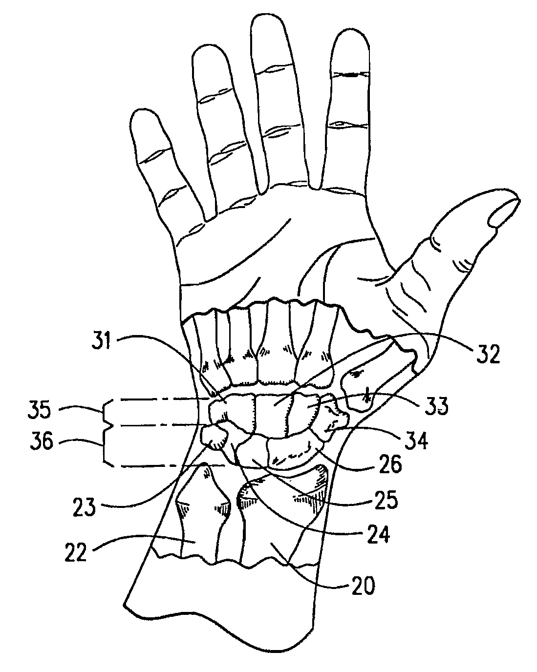 Improved Orthotic Appliance for Carpal Tunnel Syndrome