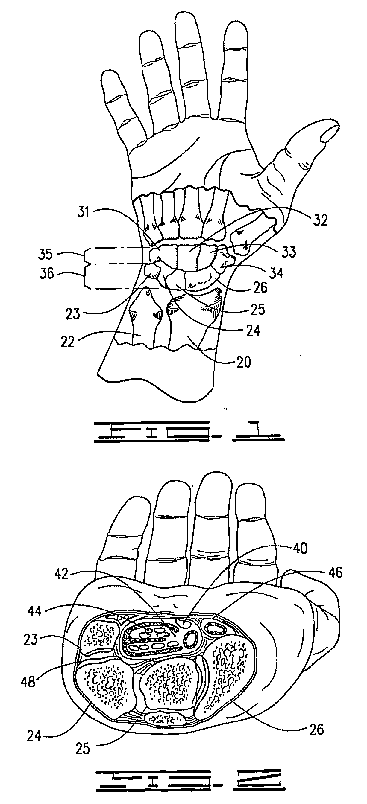 Improved Orthotic Appliance for Carpal Tunnel Syndrome