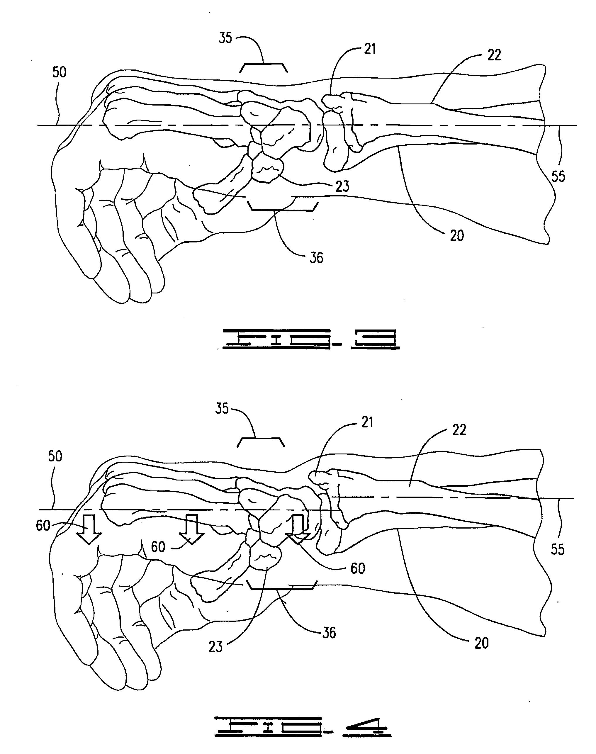 Improved Orthotic Appliance for Carpal Tunnel Syndrome