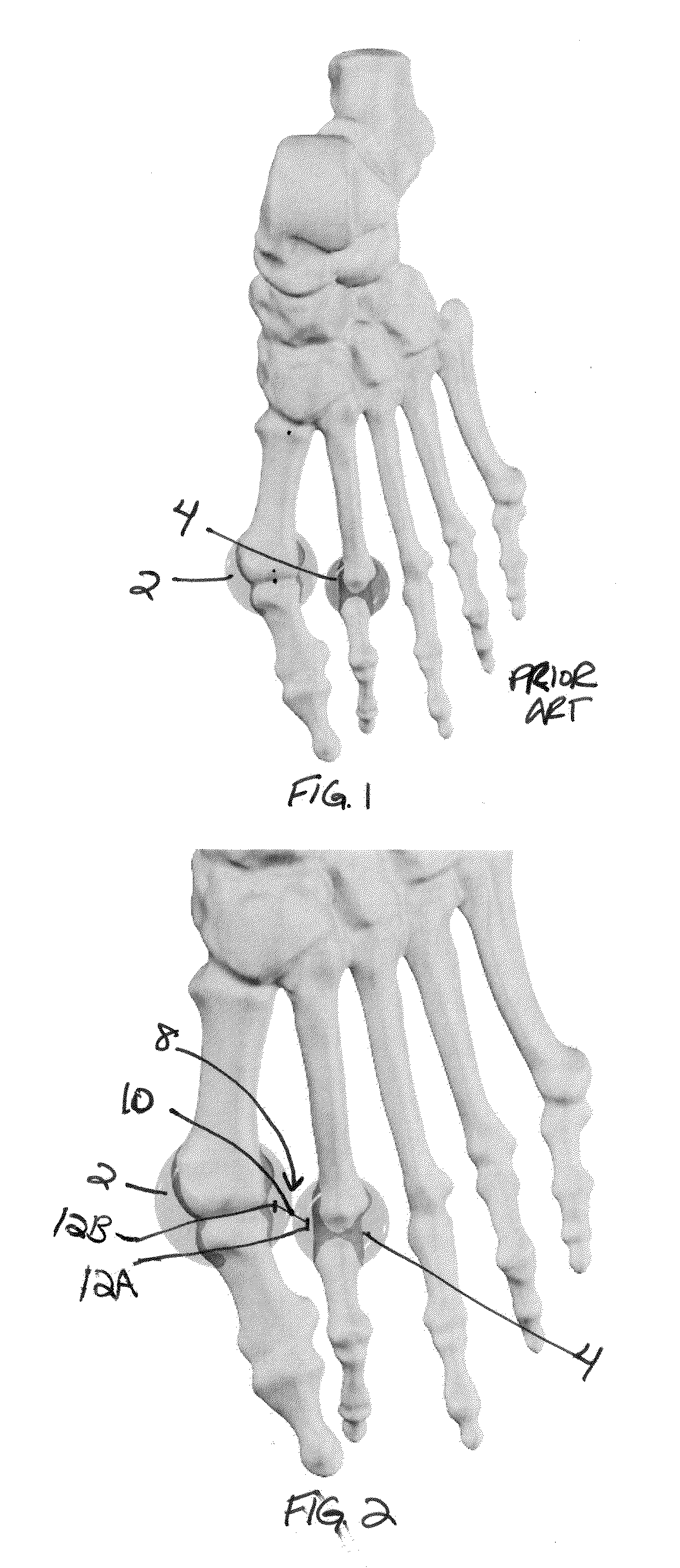 Methods and devices for treating hallux valgus