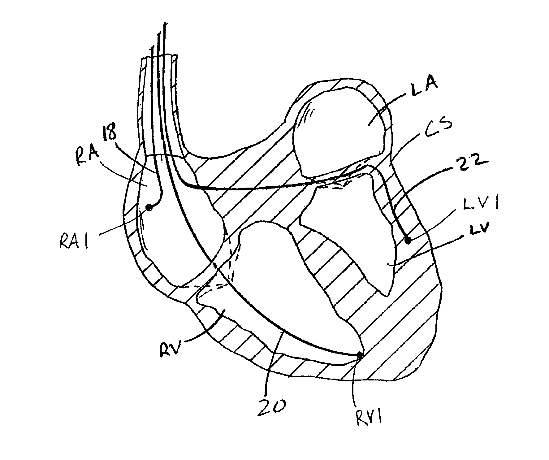 Summation anodal pacing to complement multisite stimulation