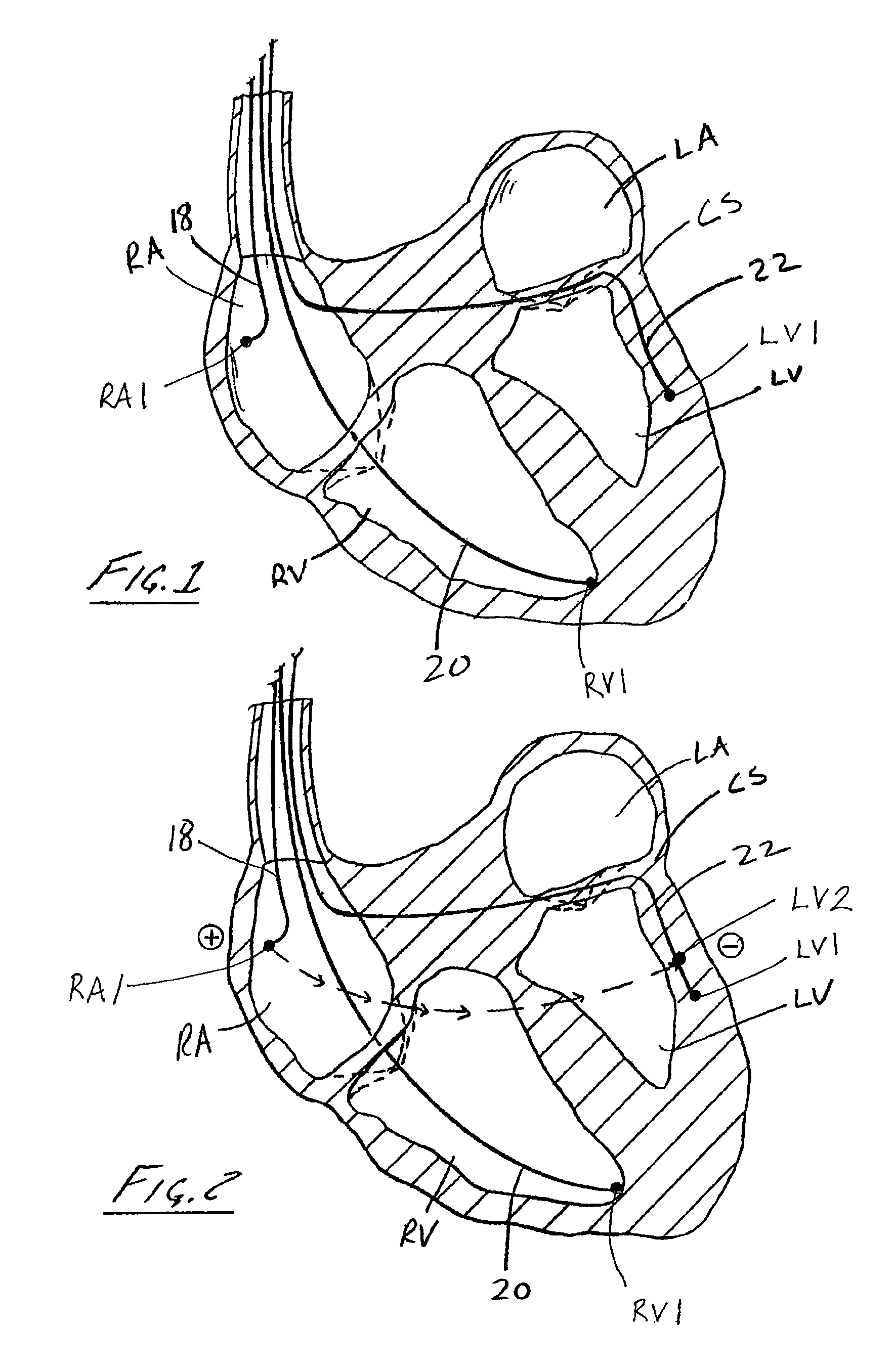 Summation anodal pacing to complement multisite stimulation