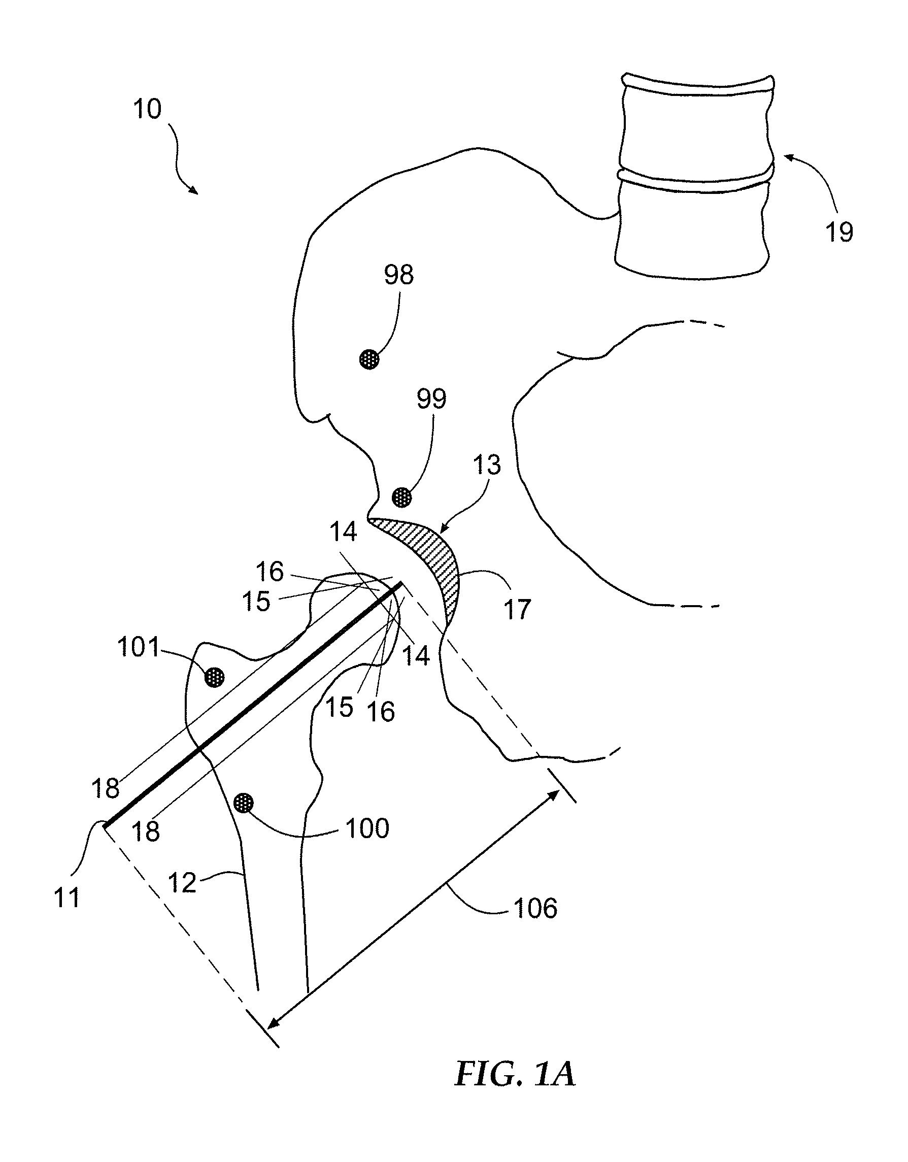 Method and Apparatus for Arthroscopic Assisted Arthroplasty of the Hip Joint