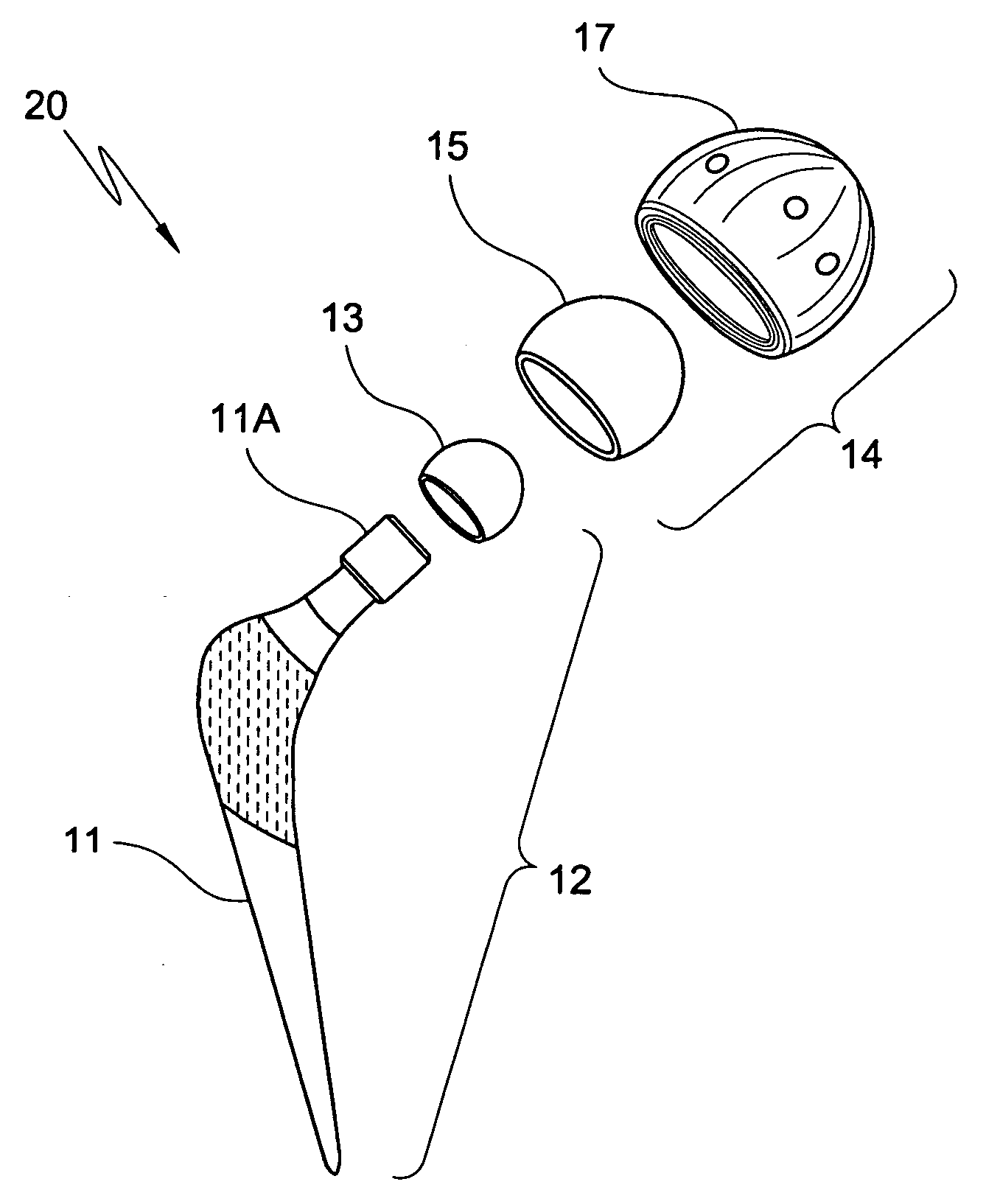 Implantable Joint Prosthesis