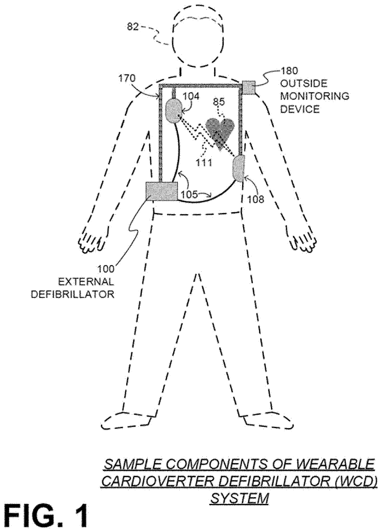 Wearable cardioverter defibrillator with ai-based features