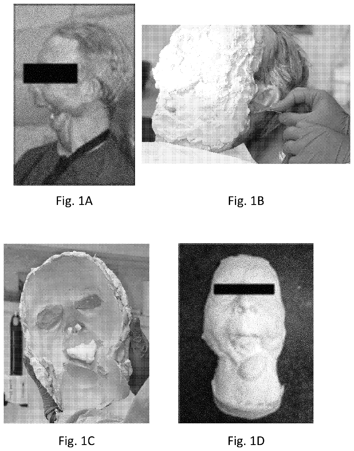 Apparatus and methods for three dimensional plasthesis prostheses