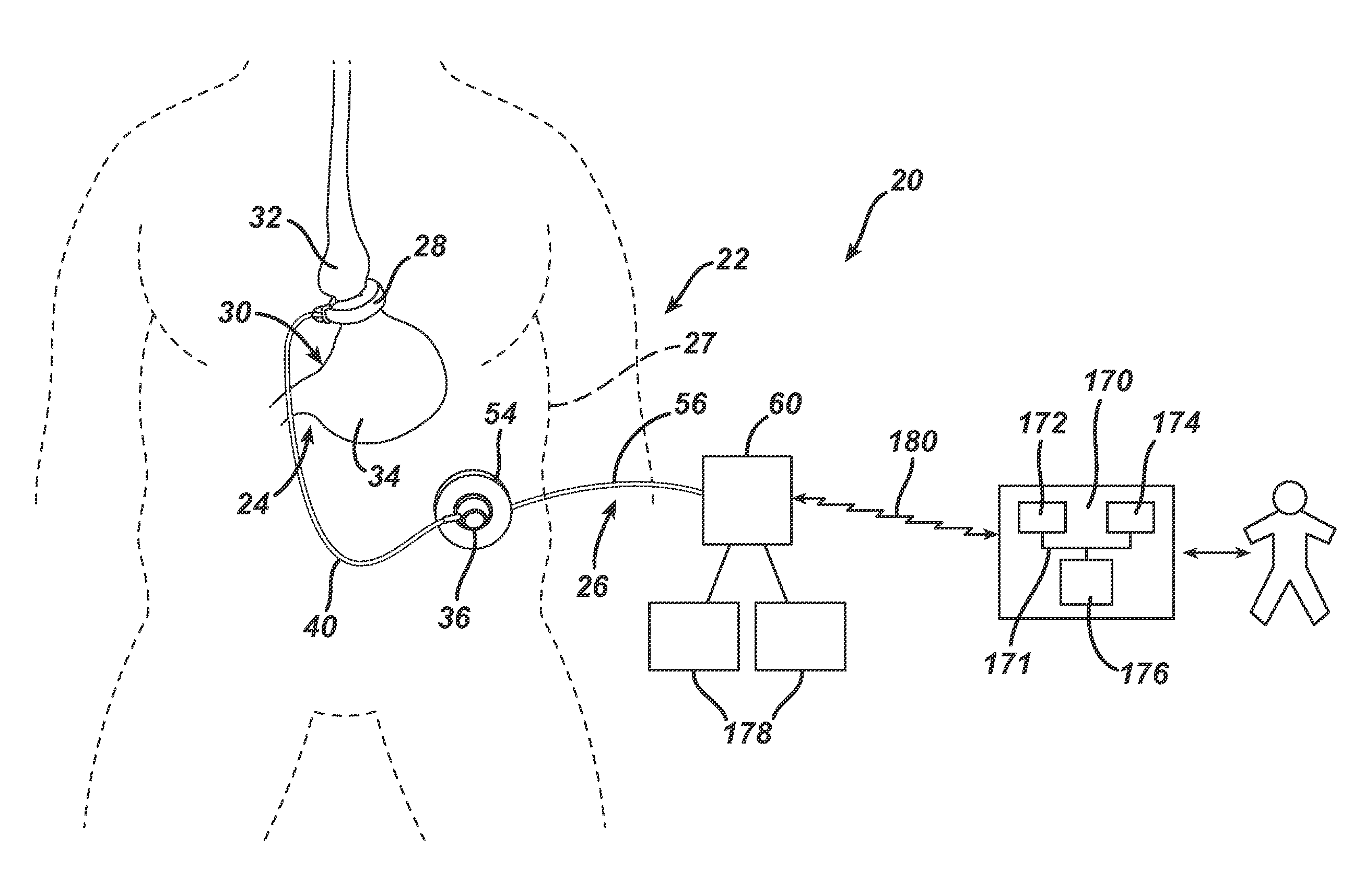 Physiological Parameter Analysis for an Implantable Restriction Device and a Data Logger