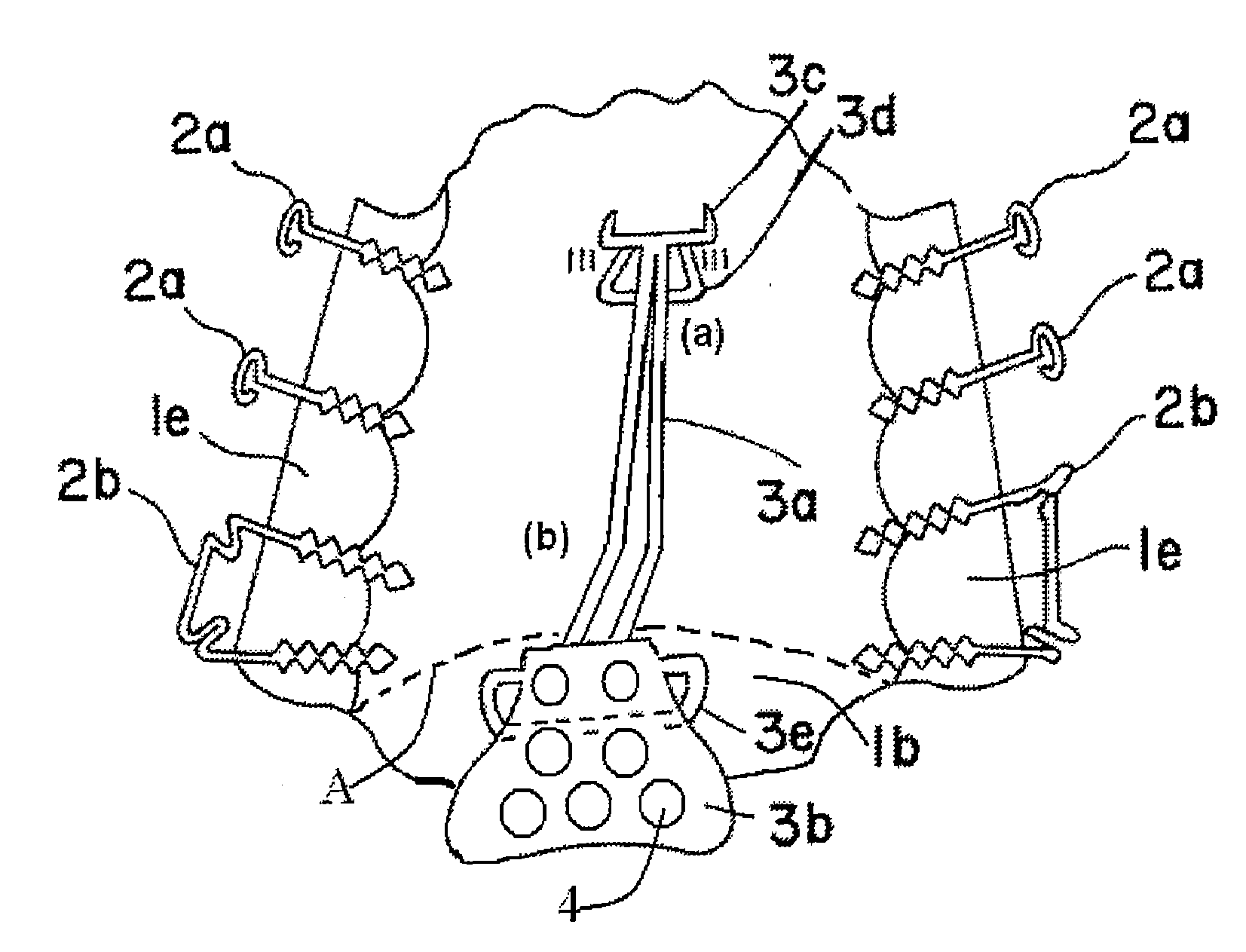 Oral orthesis for reducing snoring and sleep apnea symptoms