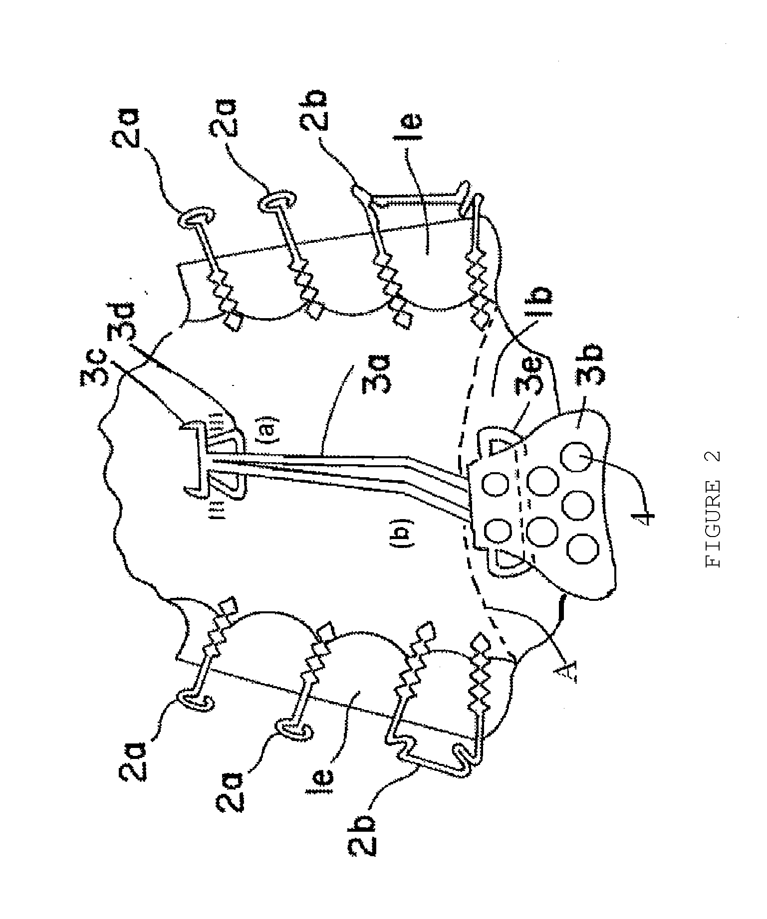 Oral orthesis for reducing snoring and sleep apnea symptoms