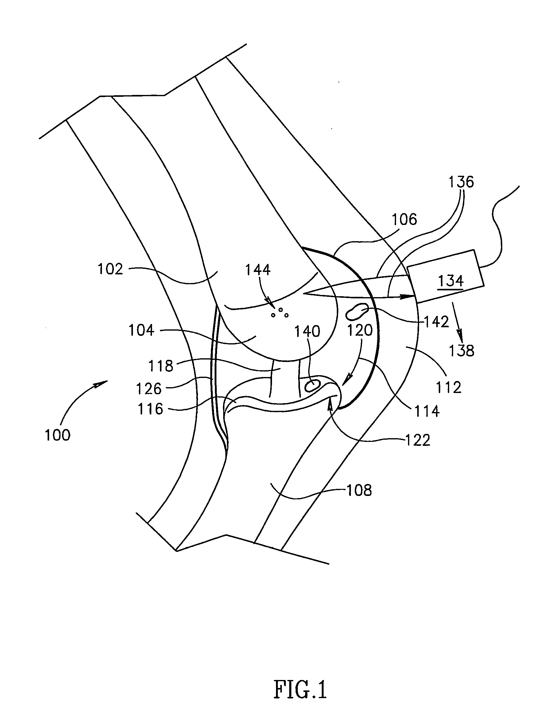 Joint analysis using ultrasound