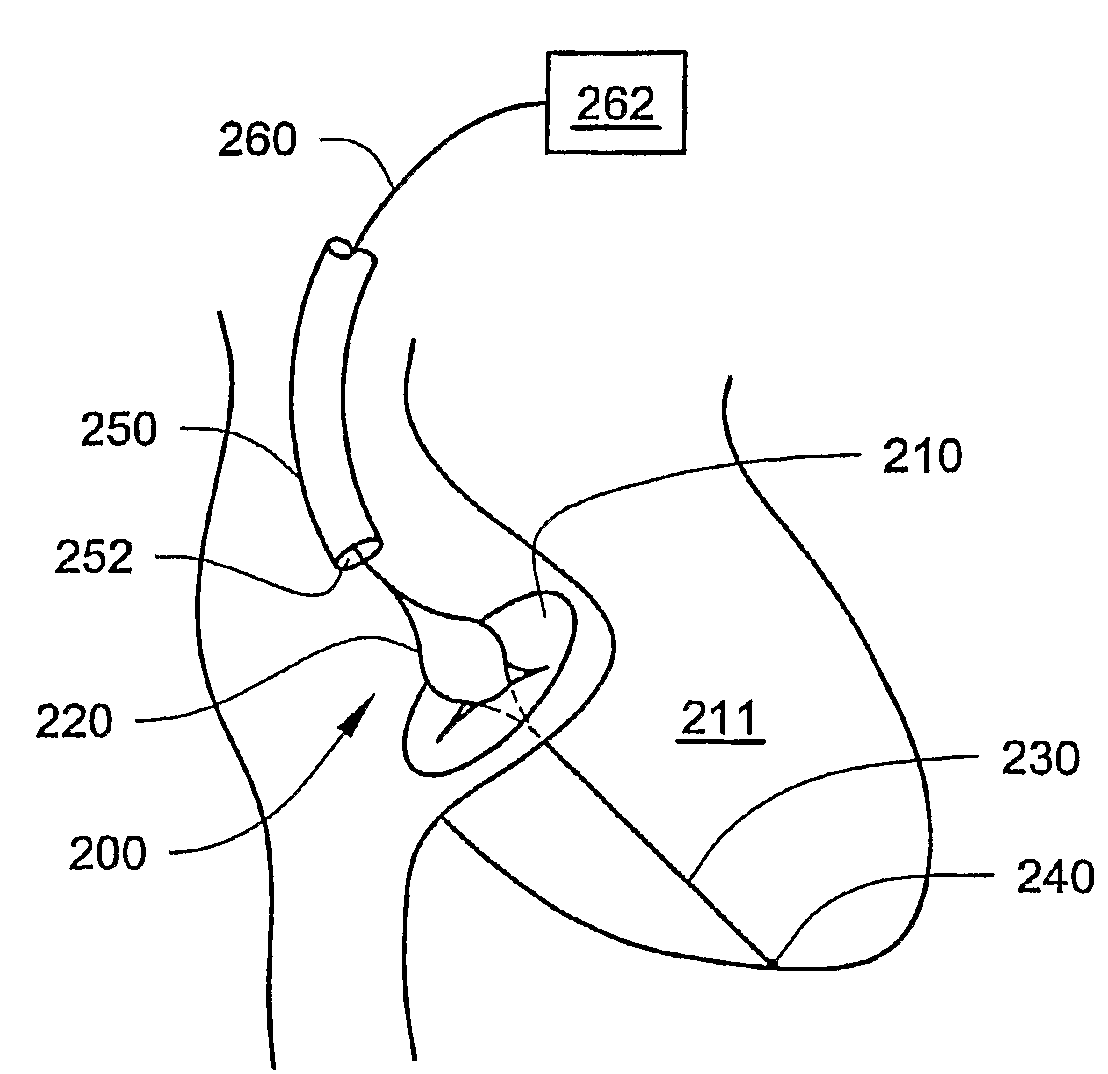 Device And Methods For Reducing Cardiac Valve Regurgitation