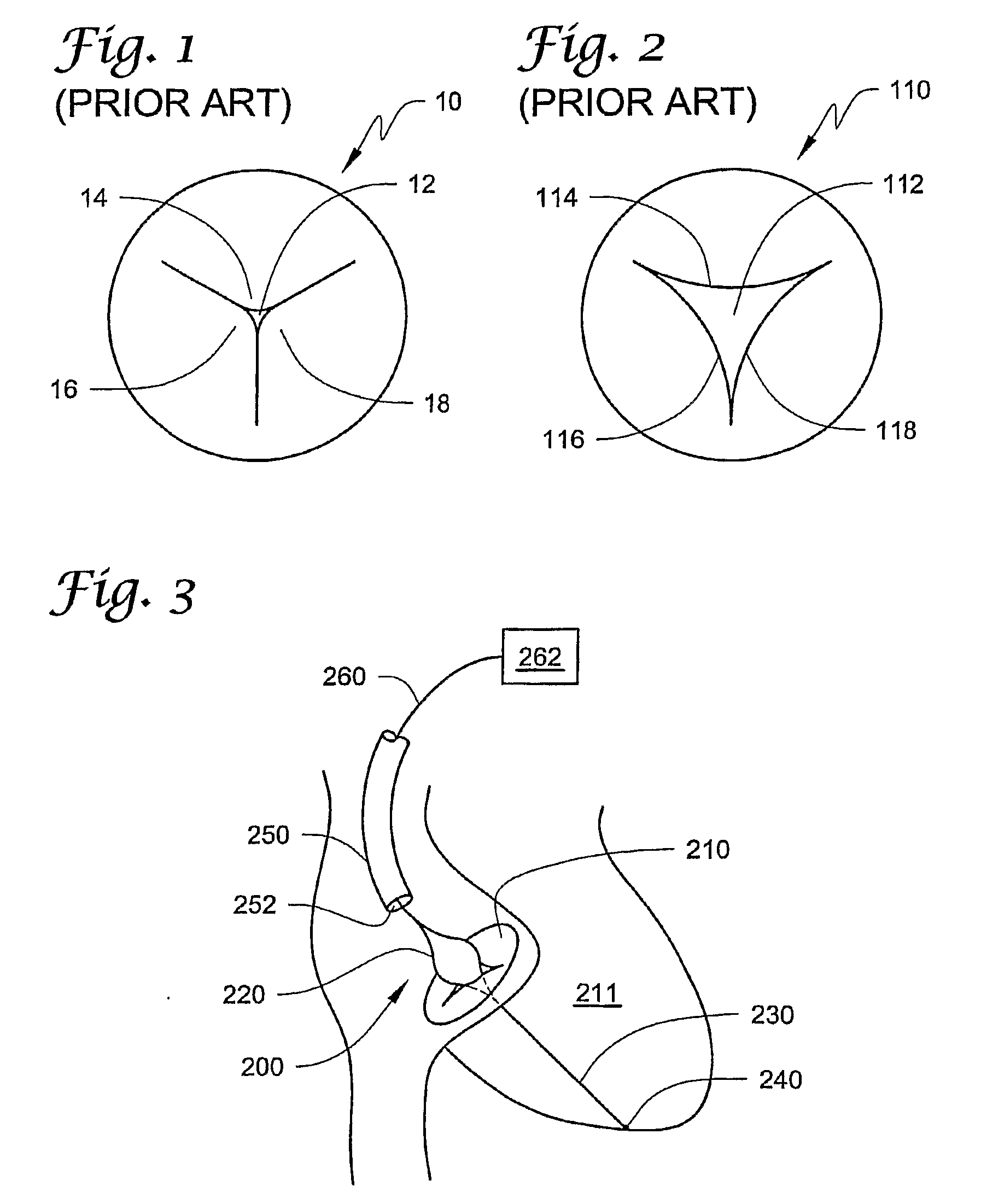 Device And Methods For Reducing Cardiac Valve Regurgitation