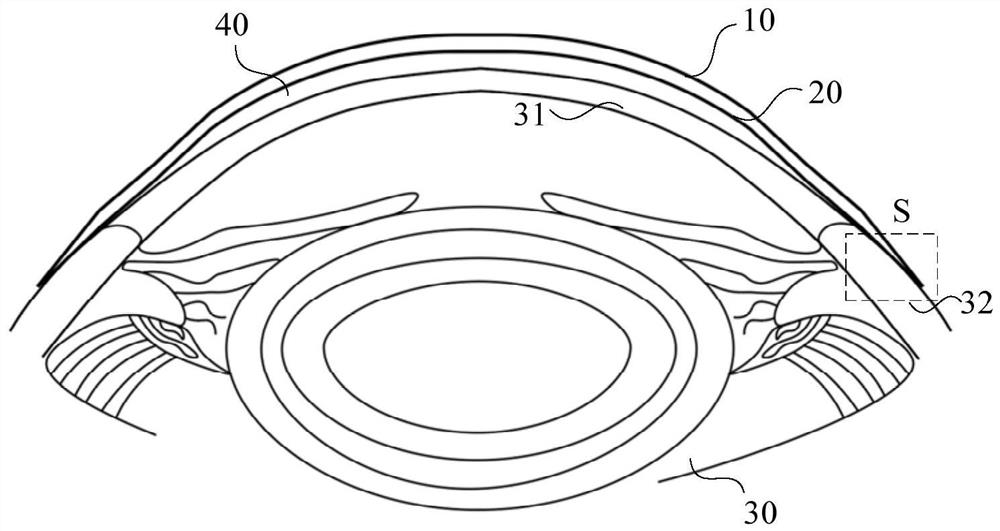 Lens in contact with sclera