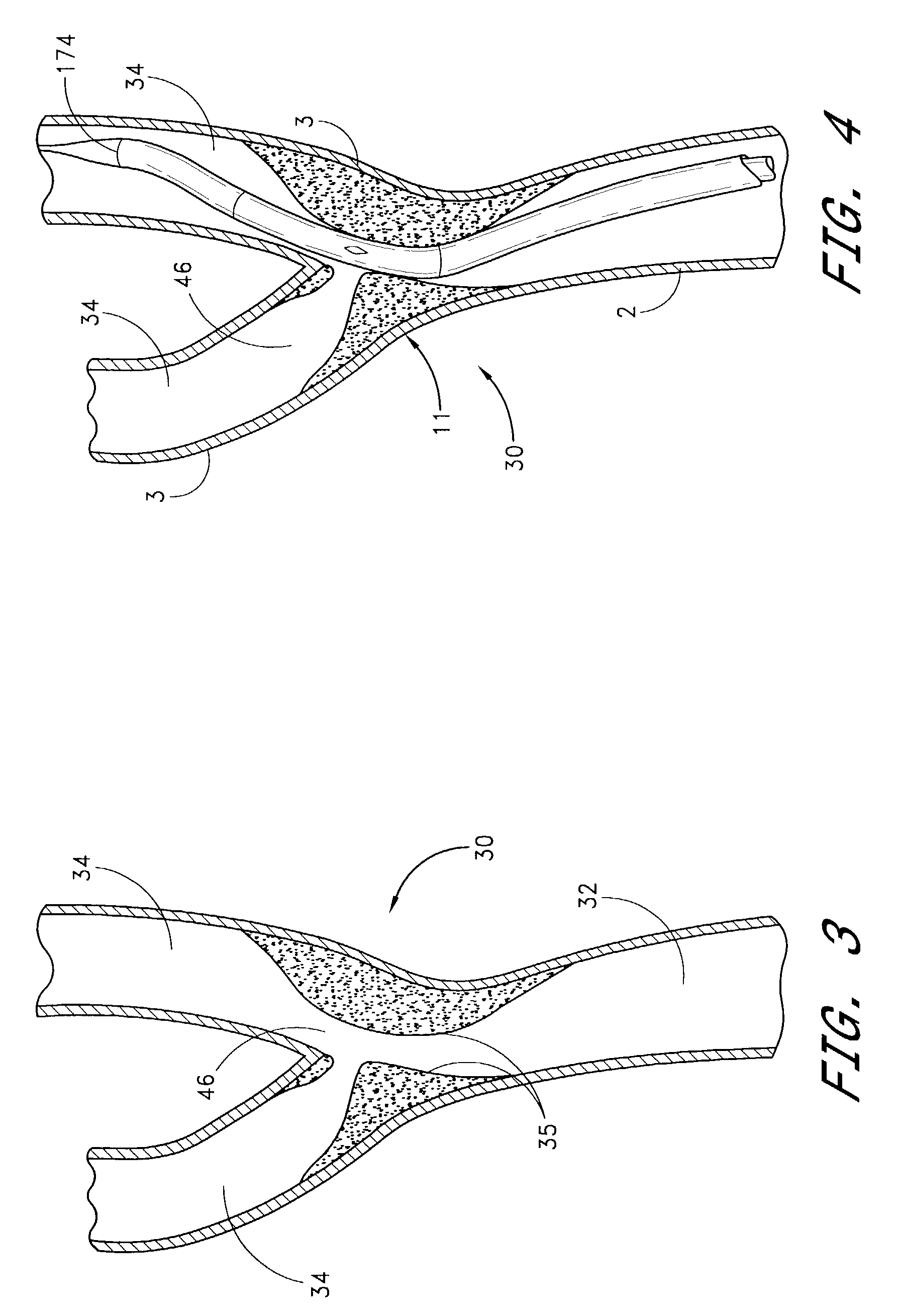 Noncylindrical drug eluting stent for treating vascular bifurcations