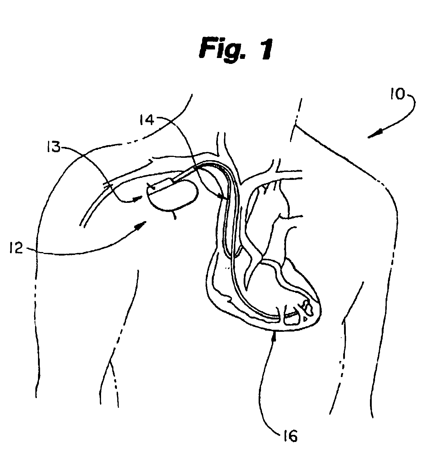 Electromagnetic interference immune tissue invasive system