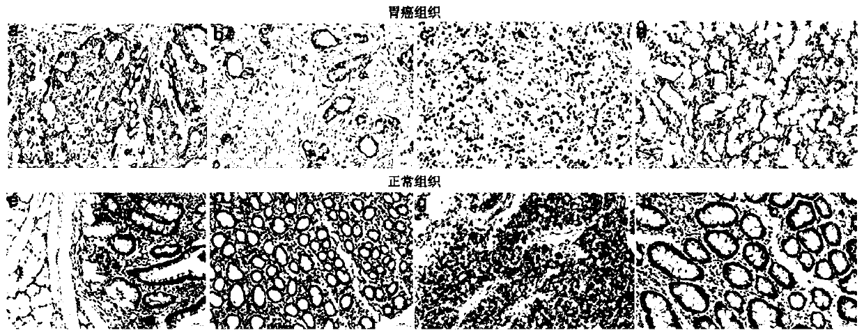 Biomarker for gastric cancer diagnosis and prognosis evaluation, application of biomarker and detection kit